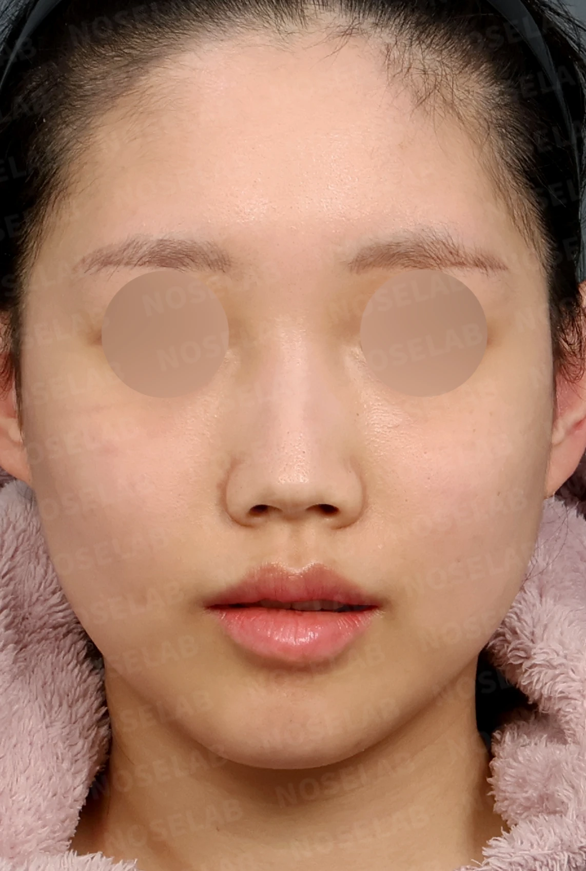 무보형물 코성형, 휘어진 콧대와 처진 코끝을 자연스럽게 교정 — 디자인 상담 정면, 좌측 측면, 비스듬한 측면 사진입니다.
