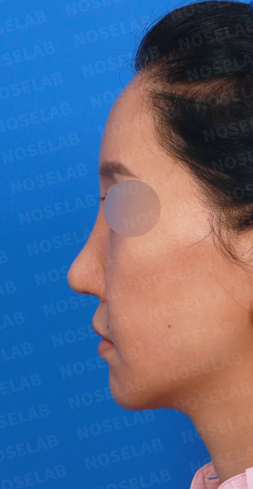 여러 번의 코재수술 뒤 비중격이 무너지는 이유, 자가늑연골 전면 재건은 어떻게 하나 — 디자인 상담 정면, 좌측 측면, 비스듬한 측면 사진입니다.