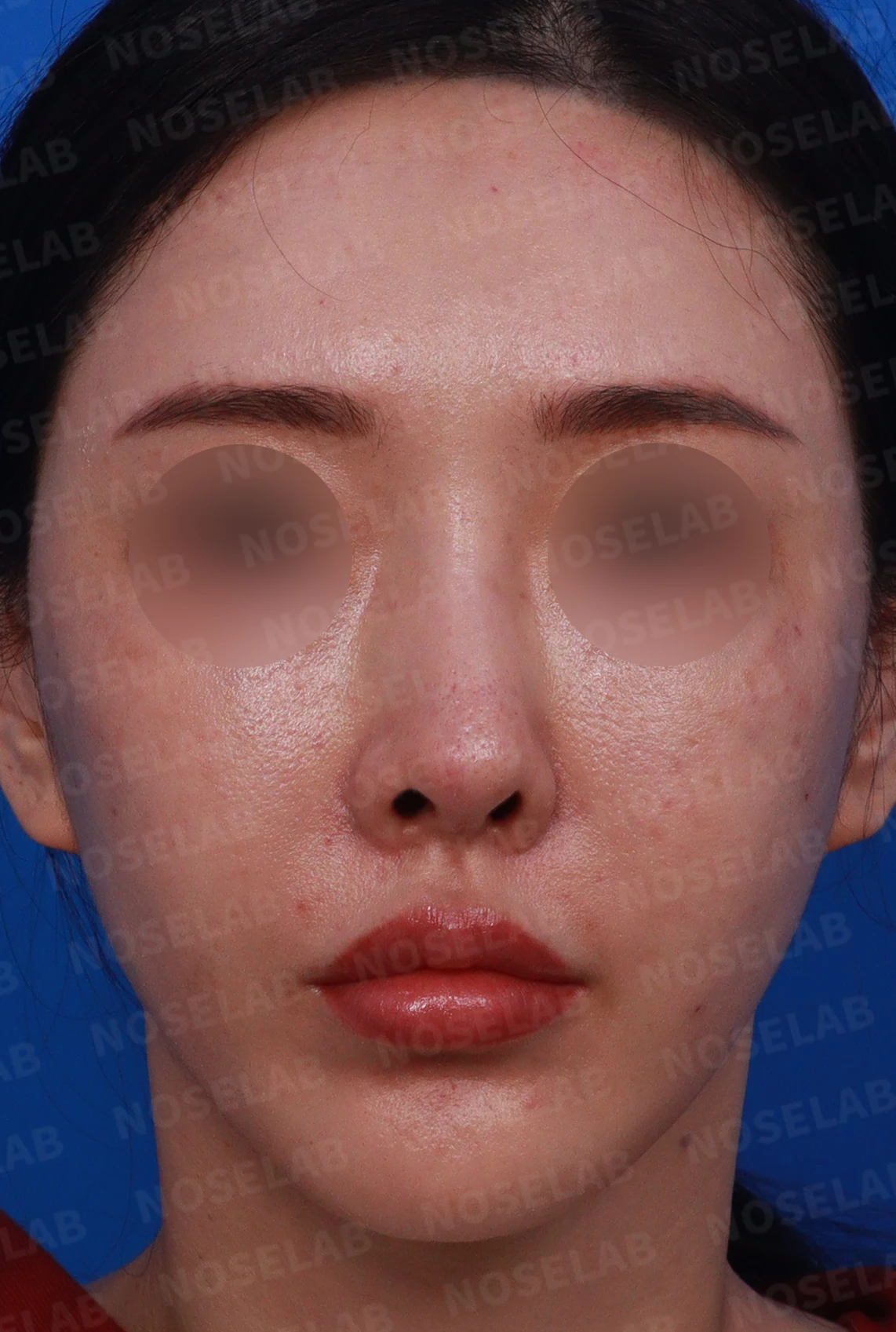 코성형 후 염증이 반복되는 이유와 자가 조직만으로 재건하는 방법 — 디자인 상담 정면 , 좌측 비스듬한 측면 , 측면 사진입니다.