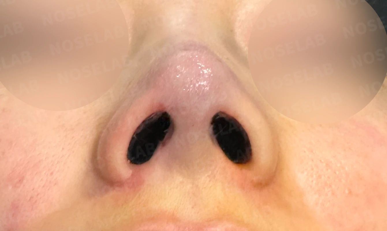 코끝이 뭉툭하게 퍼지고 코가 휘어 보이는 이유, 늑연골 재건은 어떻게 하나 — 수술 직후 0일 비공 사진입니다. 직후 사진은 부기가 있는 상태로 최종 결과와 다를 수 있습니다.