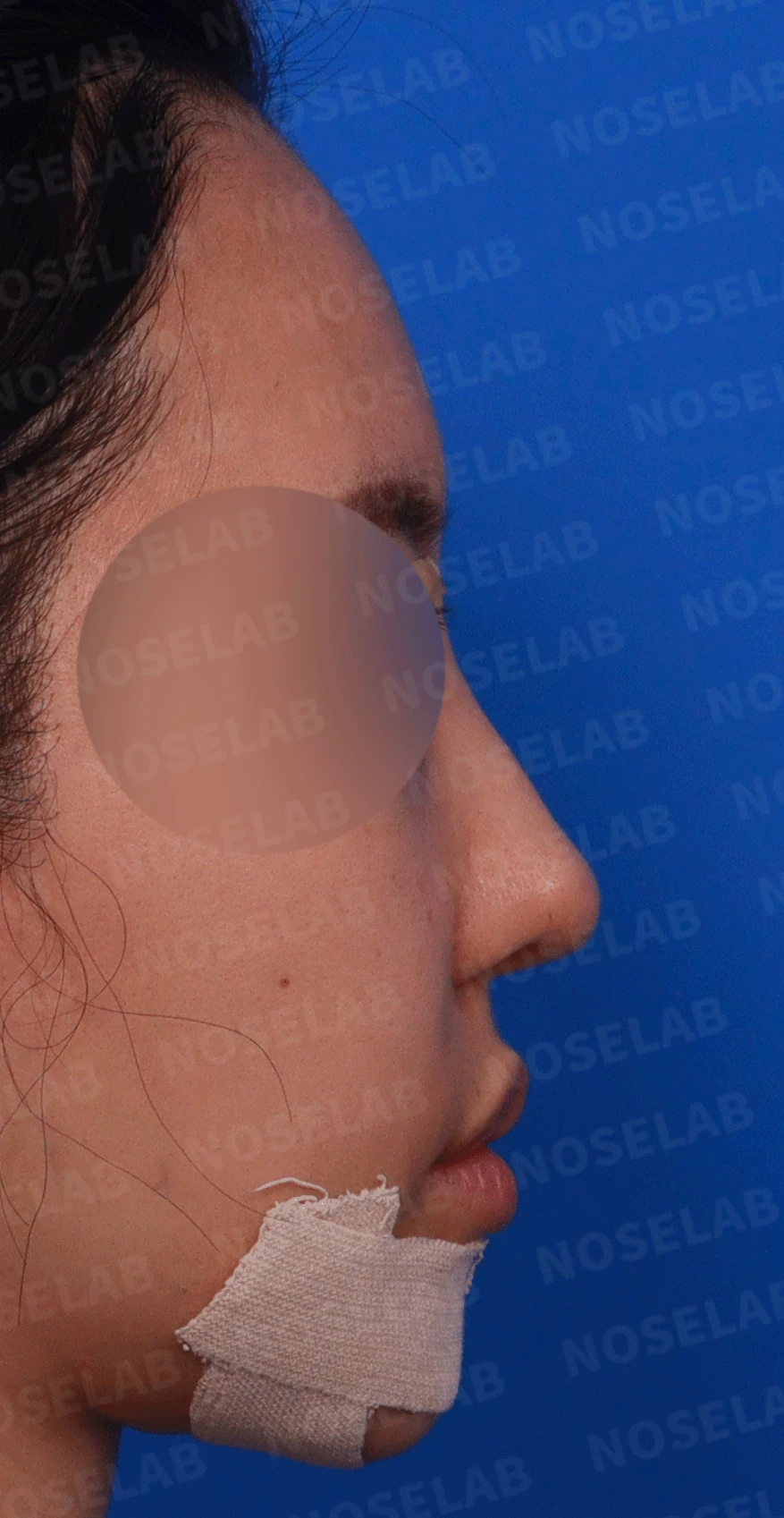 14년간 7차례 수술 후 비중격천공과 복잡한 코끝 문제 해결 - 자가늑연골 재건 실제 후기 — 디자인 상담 우측 측면, 비스듬한측면, 비공 사진입니다.