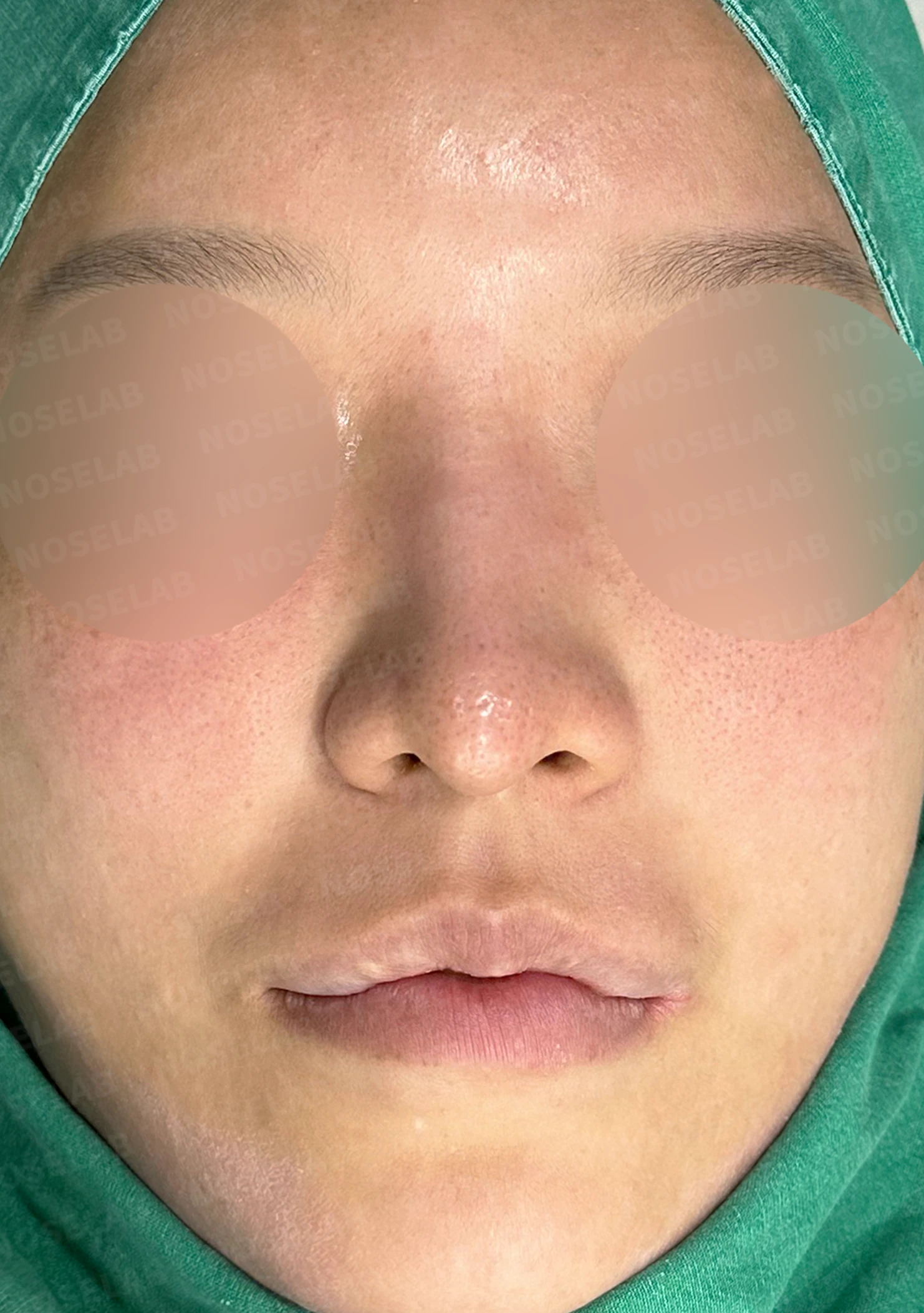 휜 코 교정과 코막힘 개선, 두 마리 토끼를 잡은 성공 사례 — 전(좌) , 직후(후)
