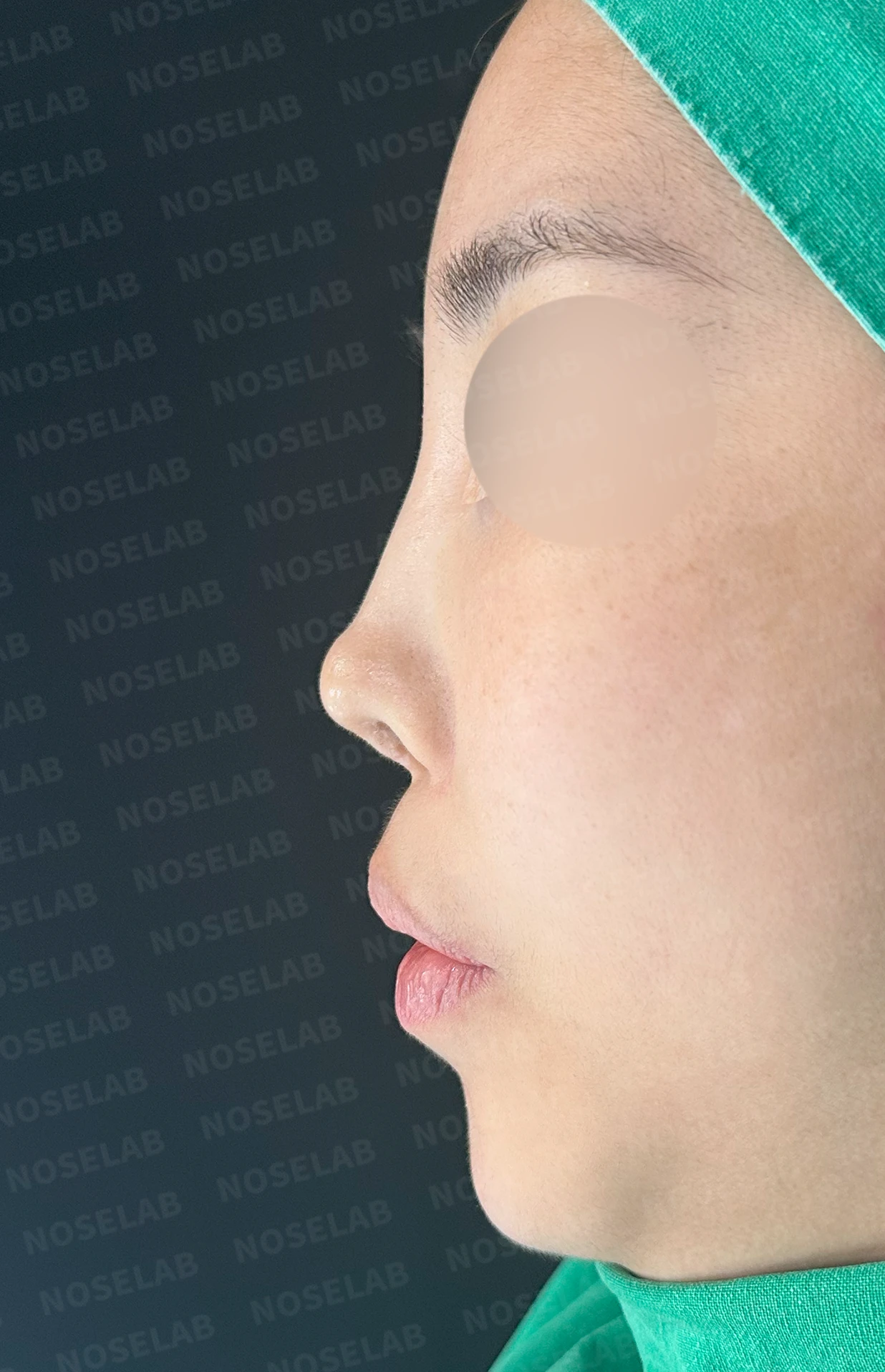 보형물을 넣고 빼기를 반복한 코에 남는 콧등 패임과 들린 느낌 — 수술 전 / 수술 직후 0일 직후 사진은 부기가 있는 상태로 최종 결과와 다를 수 있습니다.