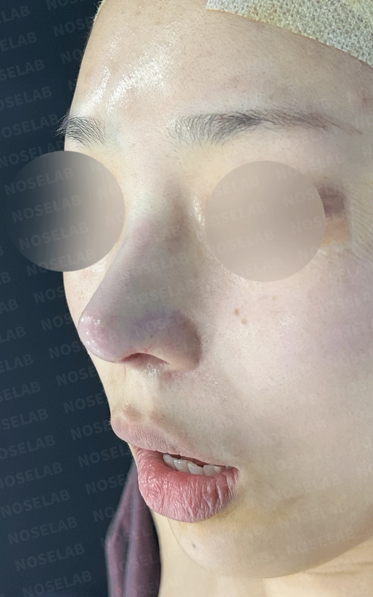 여러 번 수술한 코에 연골이 비치는 이유와 점막·구조 복원 방법 — 수술 직후 0일 정면 , 측면 , 비스듬한 측면 사진입니다. 직후 사진은 부기가 있는 상태로 최종 결과와 다를 수 있습니다.