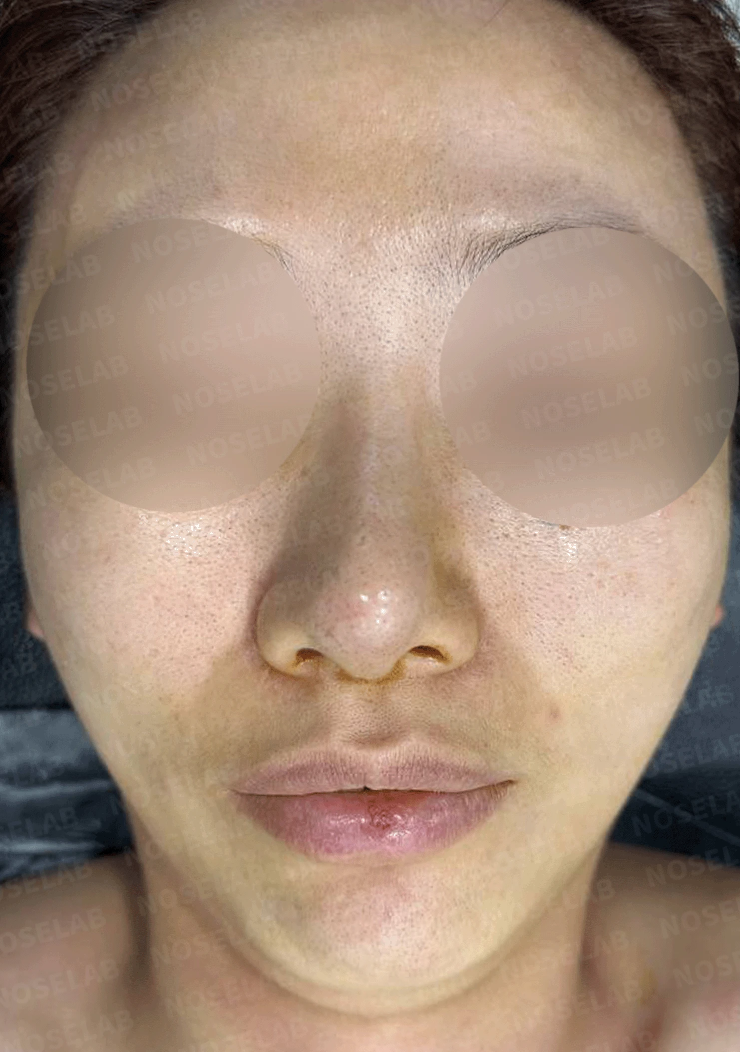 코끝 고어텍스가 문제를 일으키는 이유와 늑연골 비중격 재건 방법 — 수술 전 / 수술 직후 0일 직후 사진은 부기가 있는 상태로 최종 결과와 다를 수 있습니다.