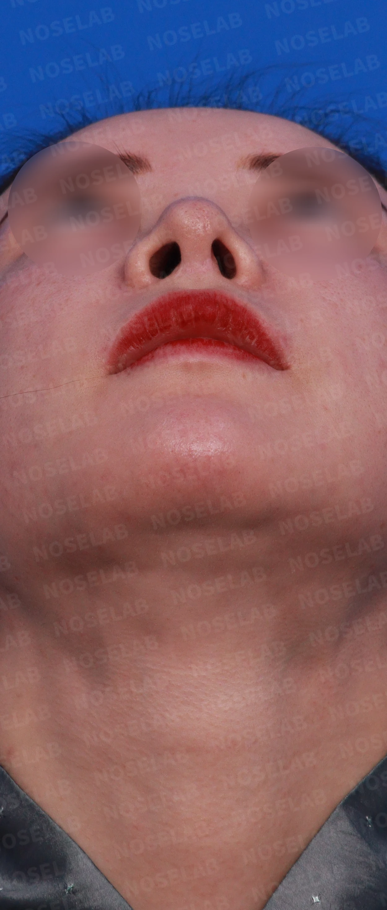 코막힘, 콧구멍비대칭 교정 사례 — 수술전 디자인 콧구멍, 우측 비스듬한 측면, 측면