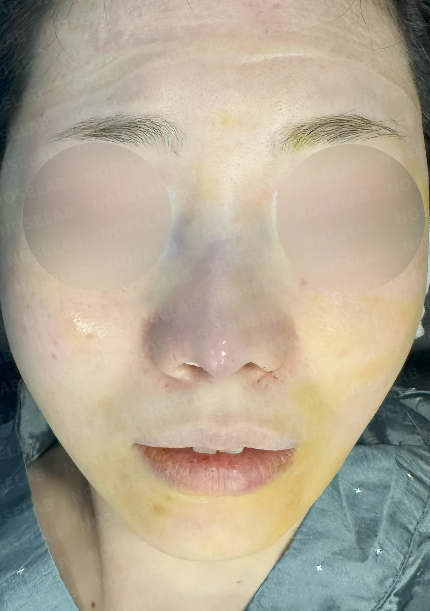 비중격 연골을 과도하게 채취하면 생기는 문제와 재건 방법 — 수술 전 / 수술 직후 0일 직후 사진은 부기가 있는 상태로 최종 결과와 다를 수 있습니다.