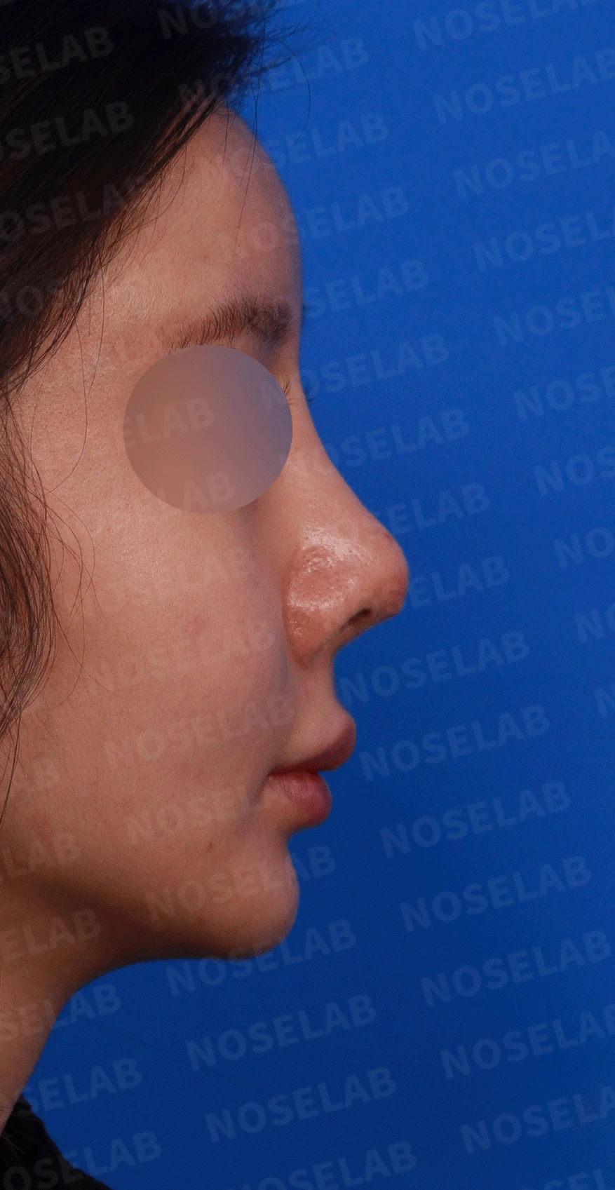 실리콘 보형물이 코끝 피부를 뚫고 나오려 할 때, 왜 생기고 어떻게 재건하나 — 디자인 상담 비공, 우측 측면, 비스듬한 측면 사진