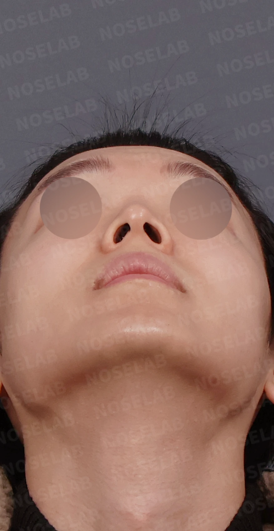 코가 낮아 보이는 이유와 자가 늑연골로 높이를 만드는 방법 — 디자인 상담 우측 측면, 비스듬한 측면, 비공 사진입니다.