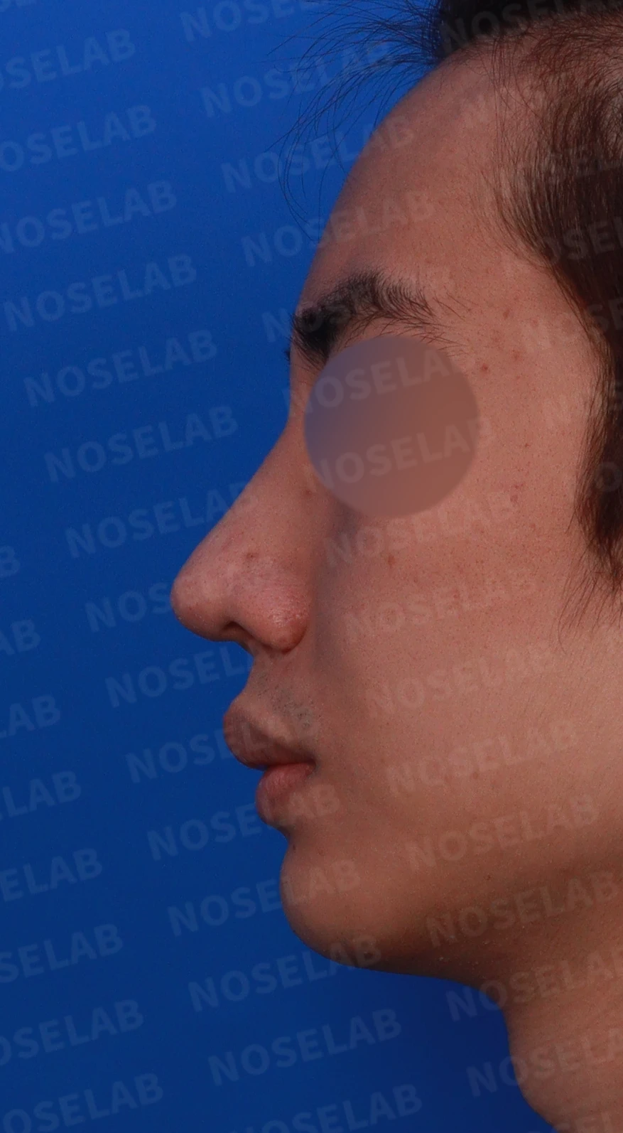 코뼈 골절에 미용 수술을 함께 할 수 있는 경우와 단계로 나누는 방법 — 디자인 상담 정면, 좌측 측면, 비스듬한 측면 사진
