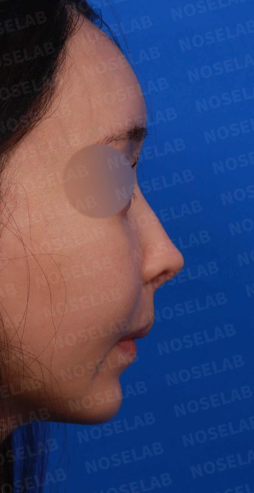뾰족한 코끝과 연골 비침의 교정 방법 — 디자인 상담 우측 측면, 비스듬한 측면, 비공 사진입니다.