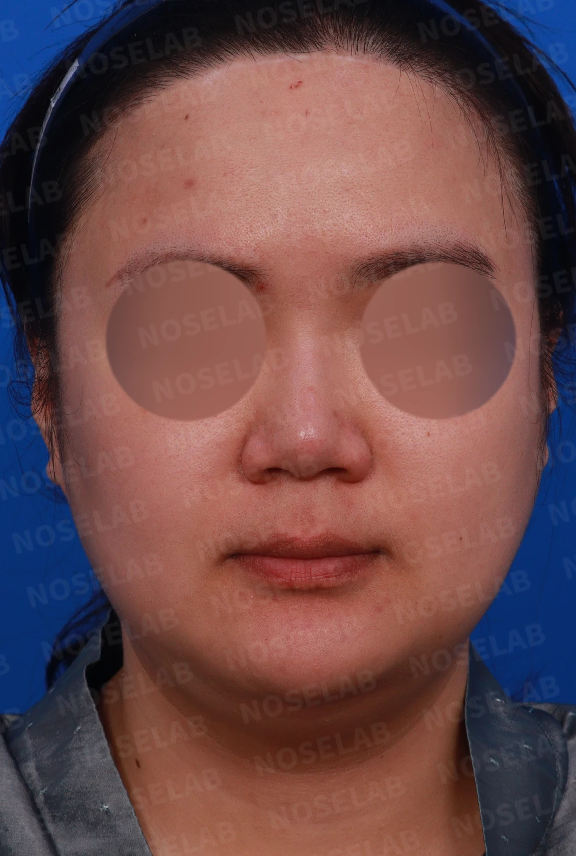 코에 삽입된 매선을 제거하고 재건하는 방법 — 디자인 상담 정면, 좌측 측면, 비스듬한 측면 사진입니다.