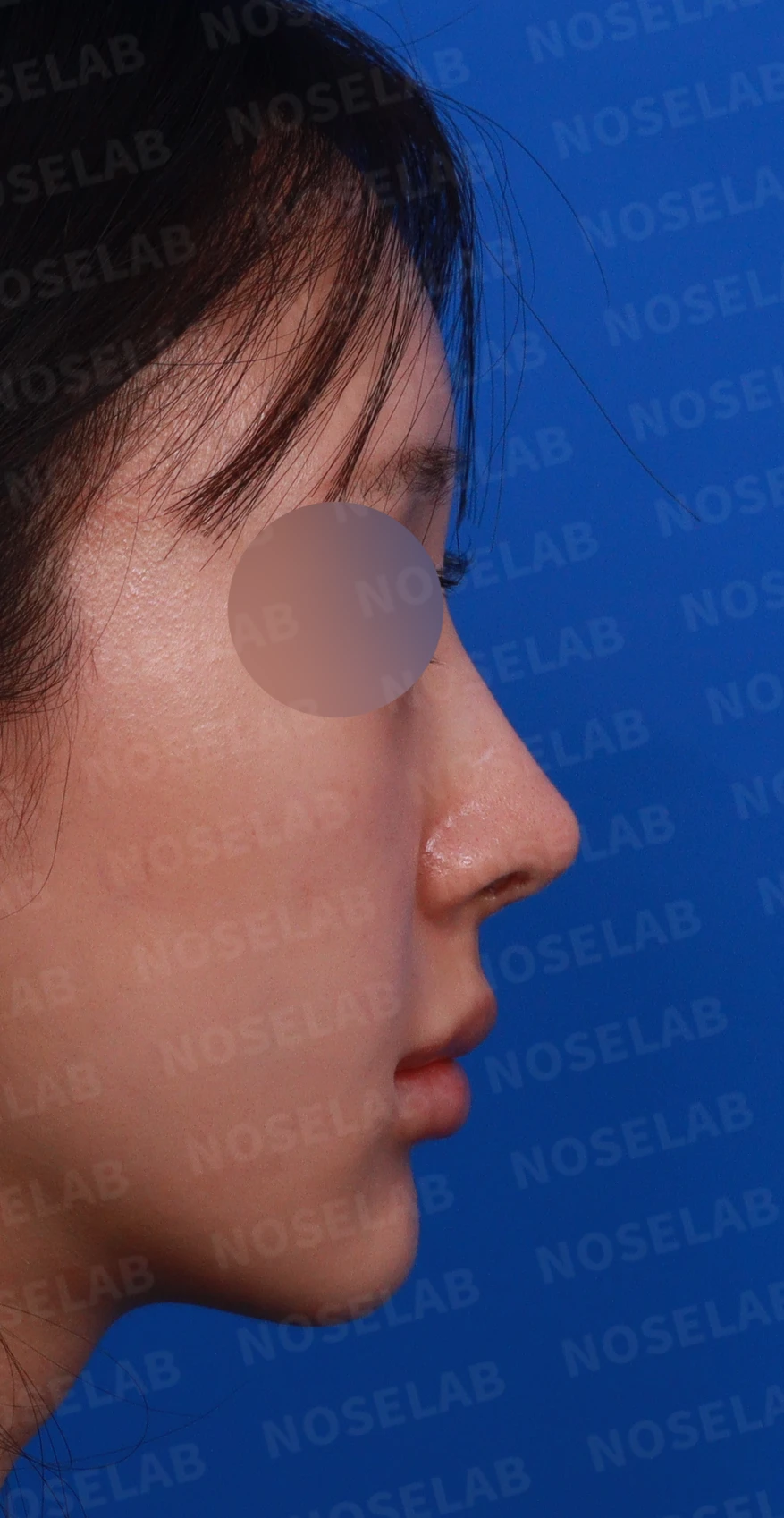 뾰족한 코끝과 연골 비침 - 자가진피 코 재수술 후기 — 디자인 상담 우측 측면, 비스듬한 측면, 비공 사진