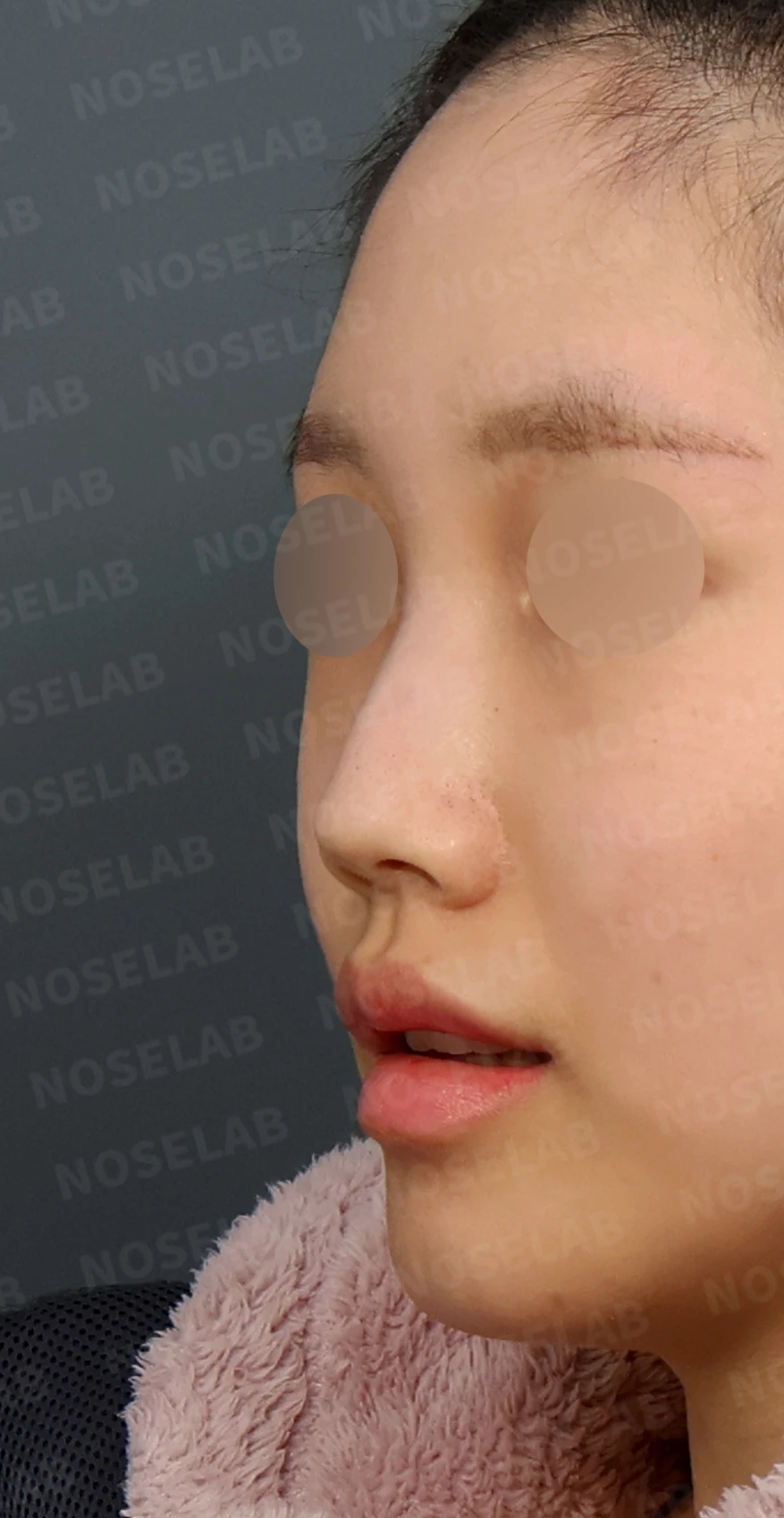 무보형물 코성형, 휘어진 콧대와 처진 코끝을 자연스럽게 교정 — 디자인 상담 정면, 좌측 측면, 비스듬한 측면 사진입니다.