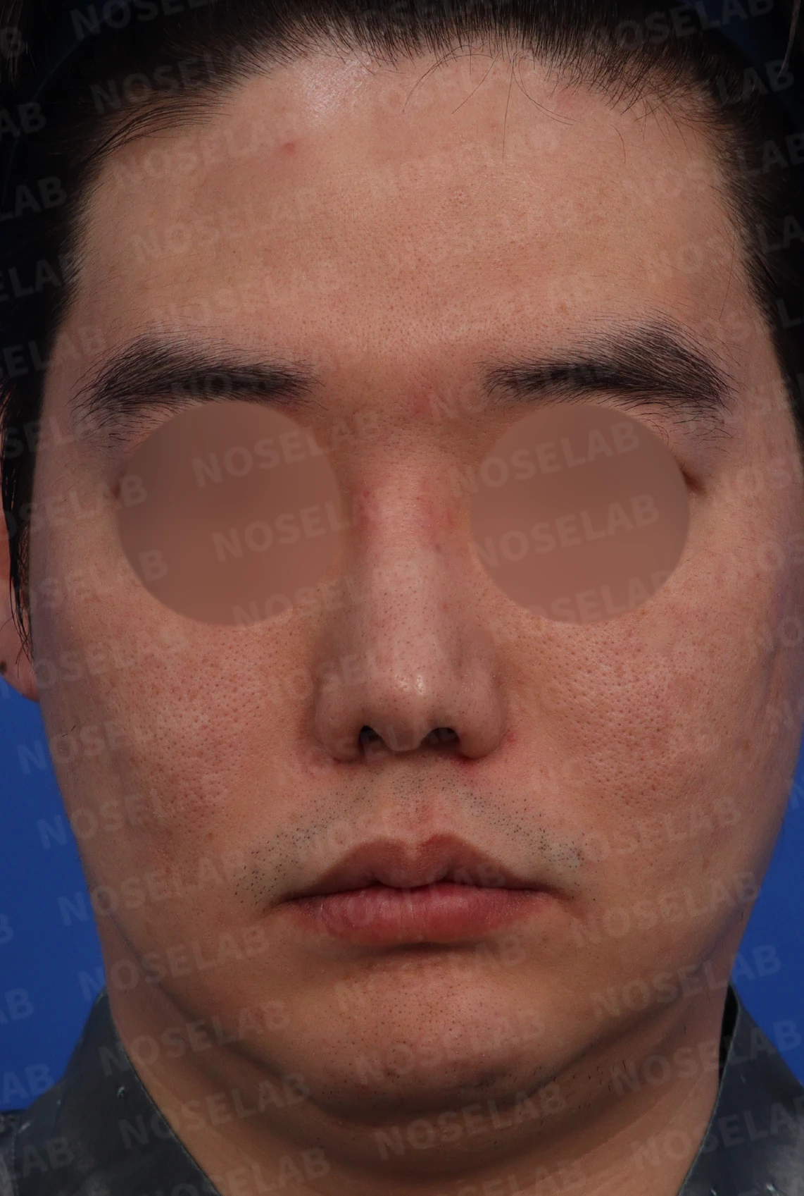 휜코와 콧구멍 비대칭을 함께 교정하는 방법 — 디자인 상담 사진 정면, 좌측 측면, 비스듬한 측면