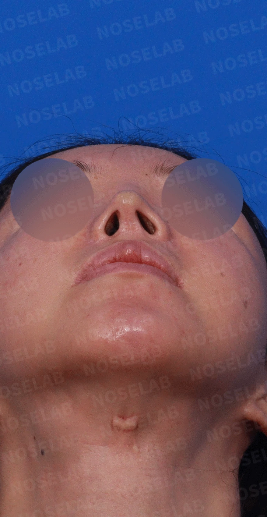 다수 재수술 후 인공진피 흡수와 비중격 손상 재건 사례 — 디자인 상담 우측 측면 , 비스듬한 측면, 비공 사진