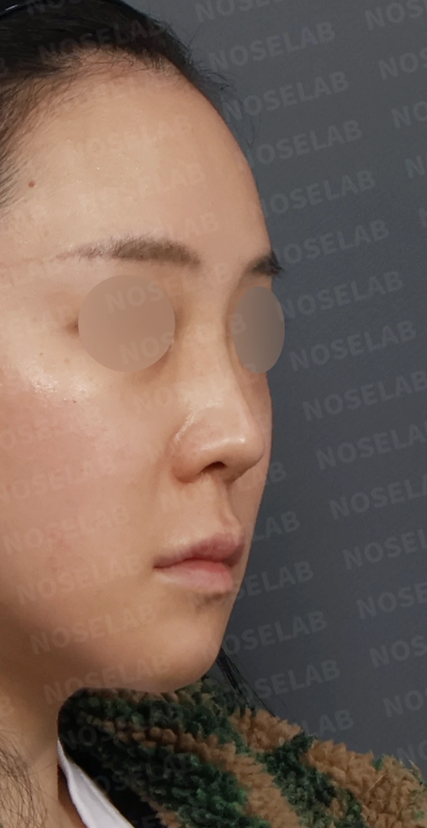 들린코 교정과 코막힘 개선, 자가늑연골로 코재수술 후기 — 디자인 상담 우측 측면, 비스듬한 측면, 비공 사진입니다.