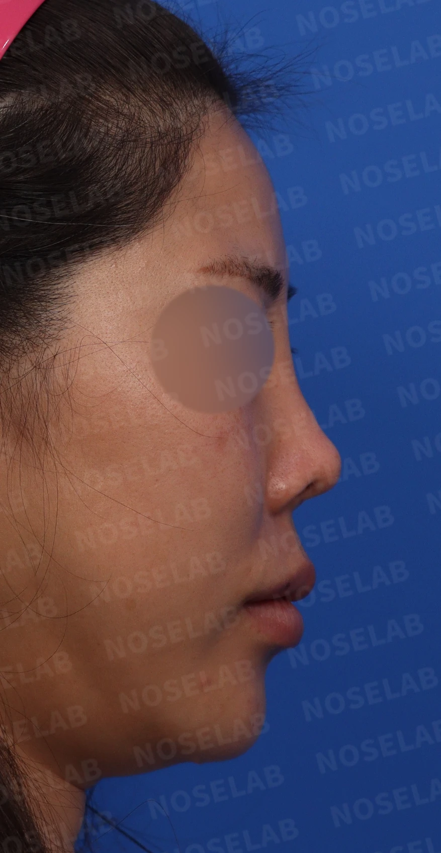 자연스러운 아름다움의 비밀: 들린코와 콧구멍 노출 교정 사례 — 본문 사진 2
