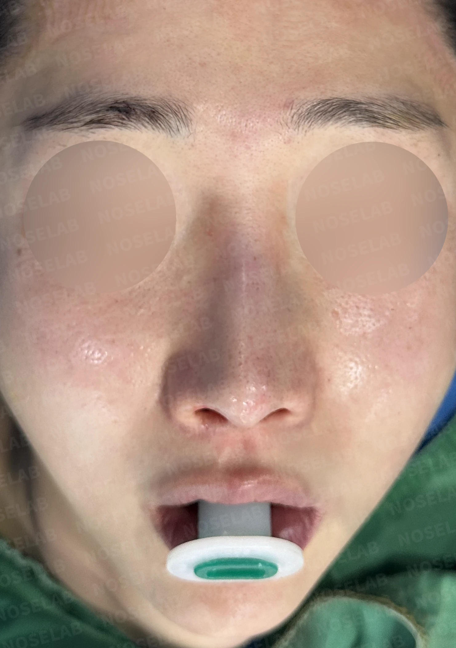 실리콘이 휘고 코가 길어 보이는 이유, 보형물 교체와 늑연골 재건은 어떻게 하나 — 수술 전 / 수술 직후 0일 직후 사진은 부기가 있는 상태로 최종 결과와 다를 수 있습니다.