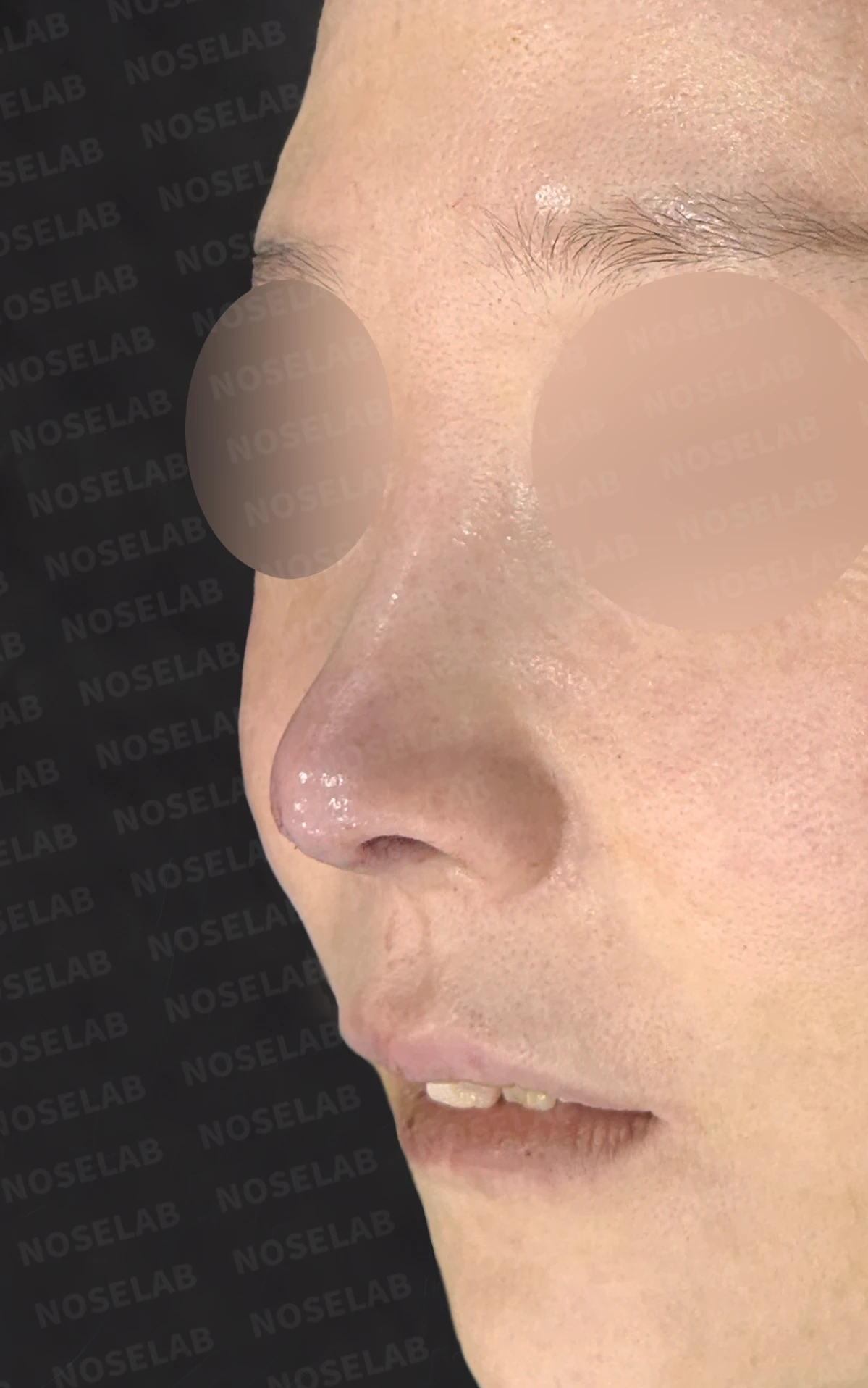 코끝 피부 함몰과 보형물 비침, 자가늑연골로 안전하게 복원한 코재수술 — 직후 정면, 비스듬한 측면, 측면 사진입니다