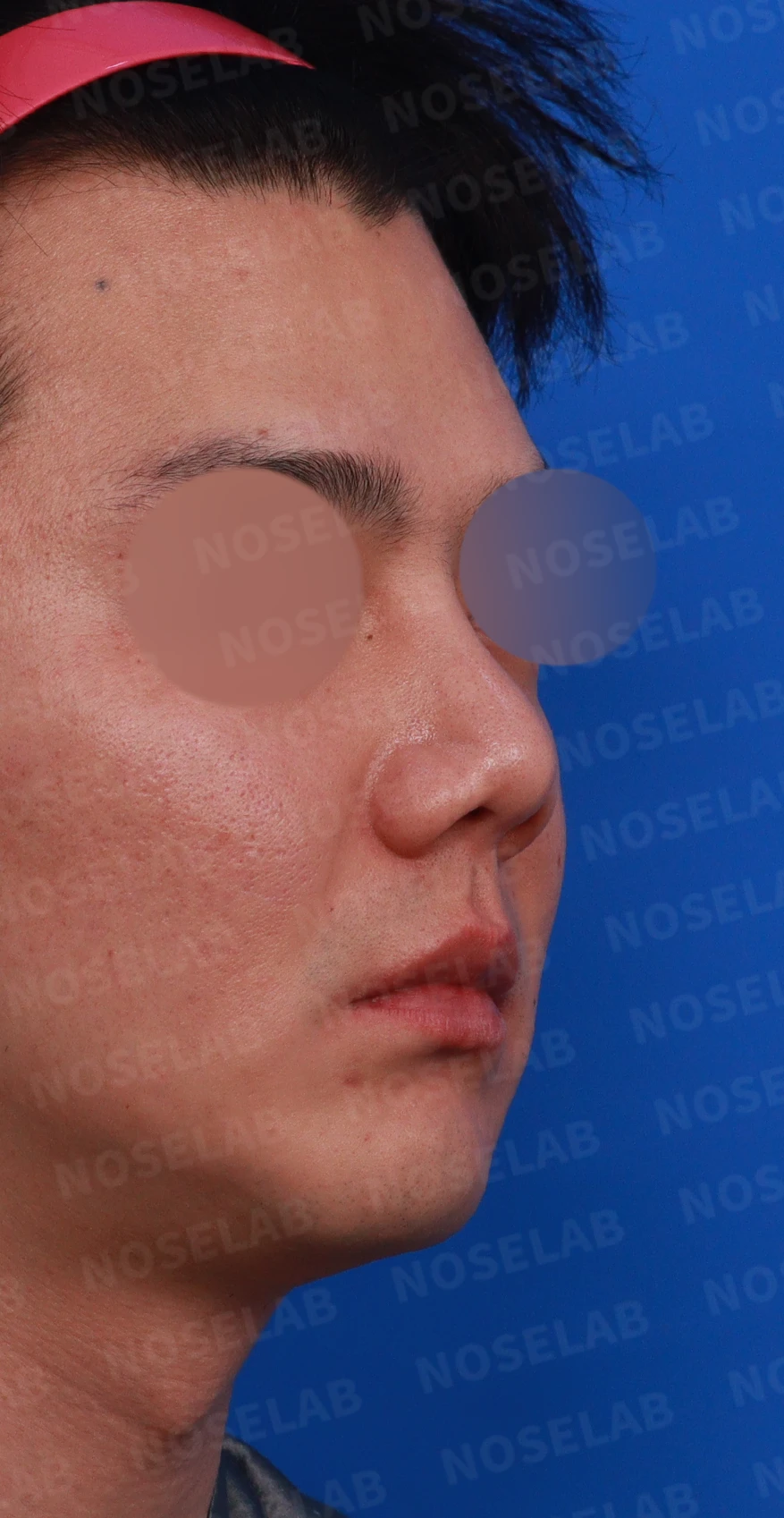 콧구멍 비대칭과 들린 코가 함께 생기는 이유, 늑연골 재건은 어떻게 하나 — 디자인 상담 우측 비스듬한 측면, 측면, 비공 사진
