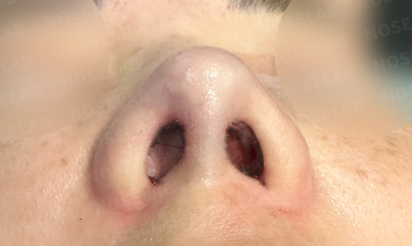 콧대가 평행선처럼 보이는 조건과 콧구멍 모양을 정하는 기준 — 수술 전 / 수술 직후 0일 직후 사진은 부기가 있는 상태로 최종 결과와 다를 수 있습니다.