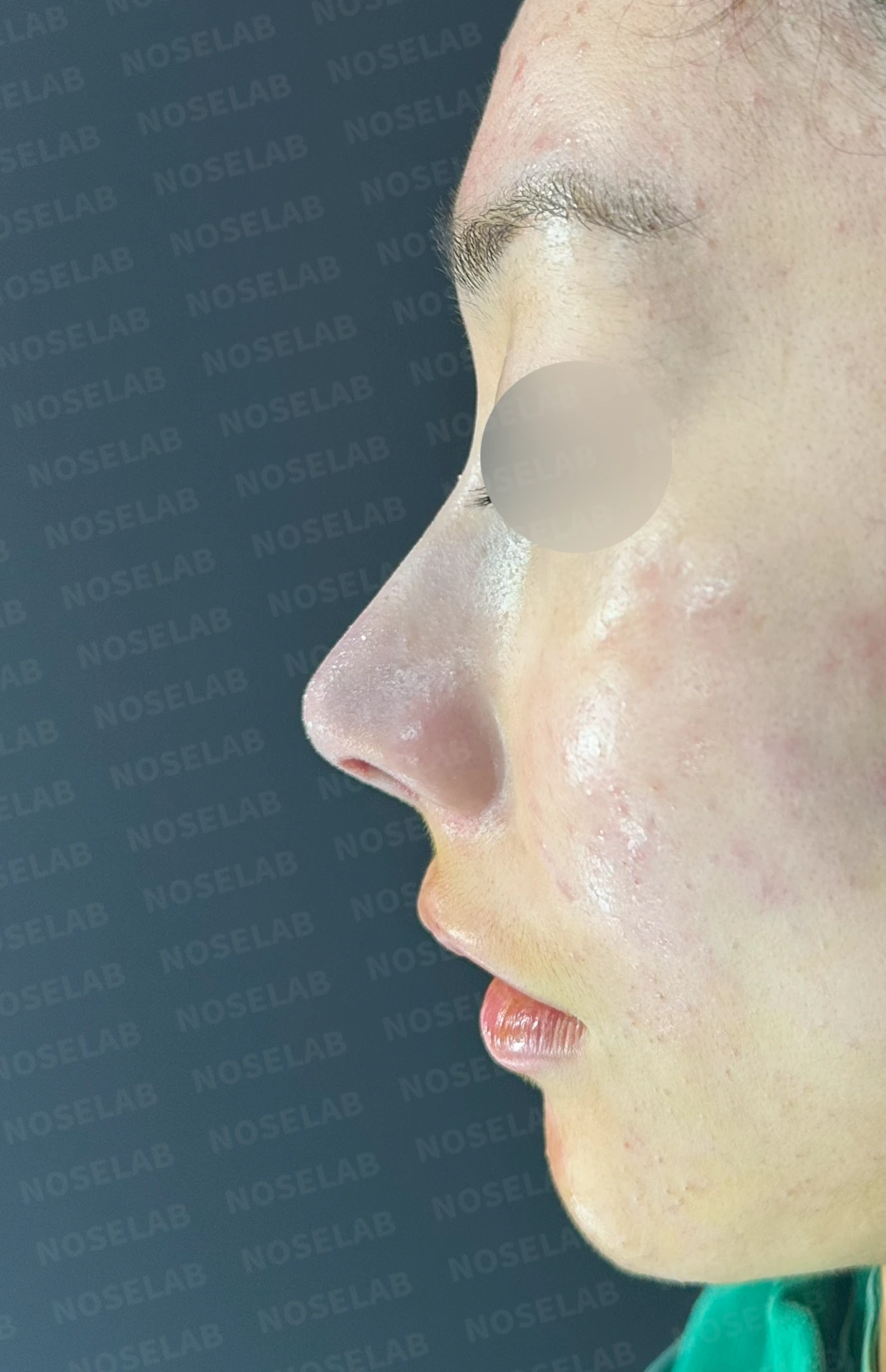 코끝이 뭉툭하게 퍼지고 코가 휘어 보이는 이유, 늑연골 재건은 어떻게 하나 — 수술 직후 0일 정면 , 측면 , 비스듬한 측면 사진입니다. 직후 사진은 부기가 있는 상태로 최종 결과와 다를 수 있습니다.