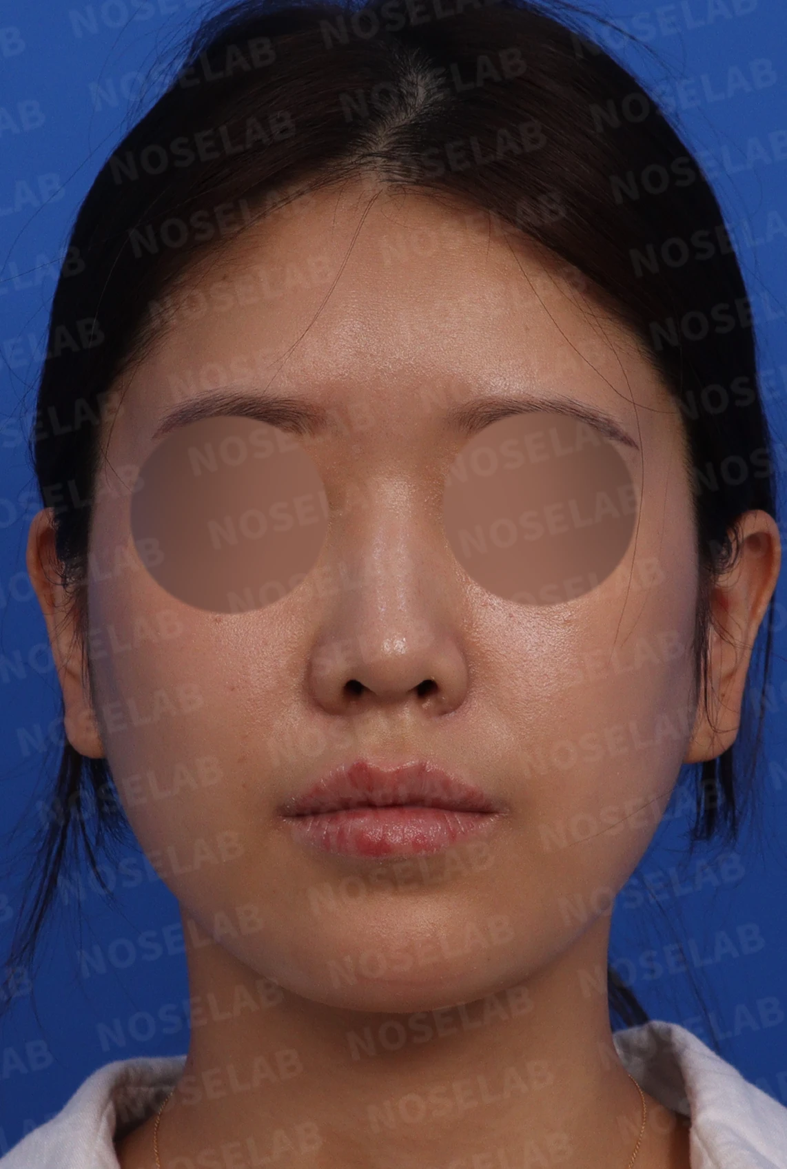 돌출입과 비순각을 함께 살펴보는 코성형 계획 — 수술전 디자인 상담 정면, 좌측 비스듬한 측면, 측면 사진입니다.