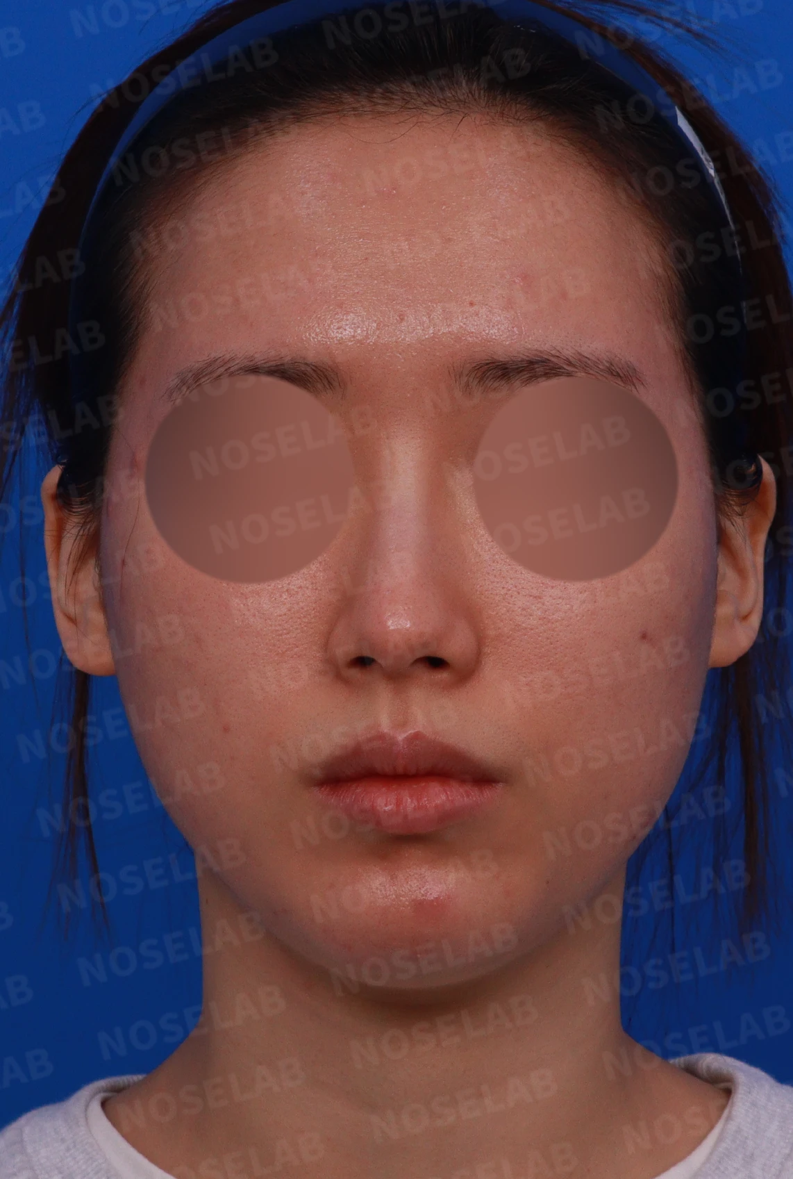코 필러 뒤에도 휜 코와 코막힘이 남는 이유, 교정은 어떻게 하나 — 디자인 상담 정면, 좌측 측면, 비스듬한 측면 사진