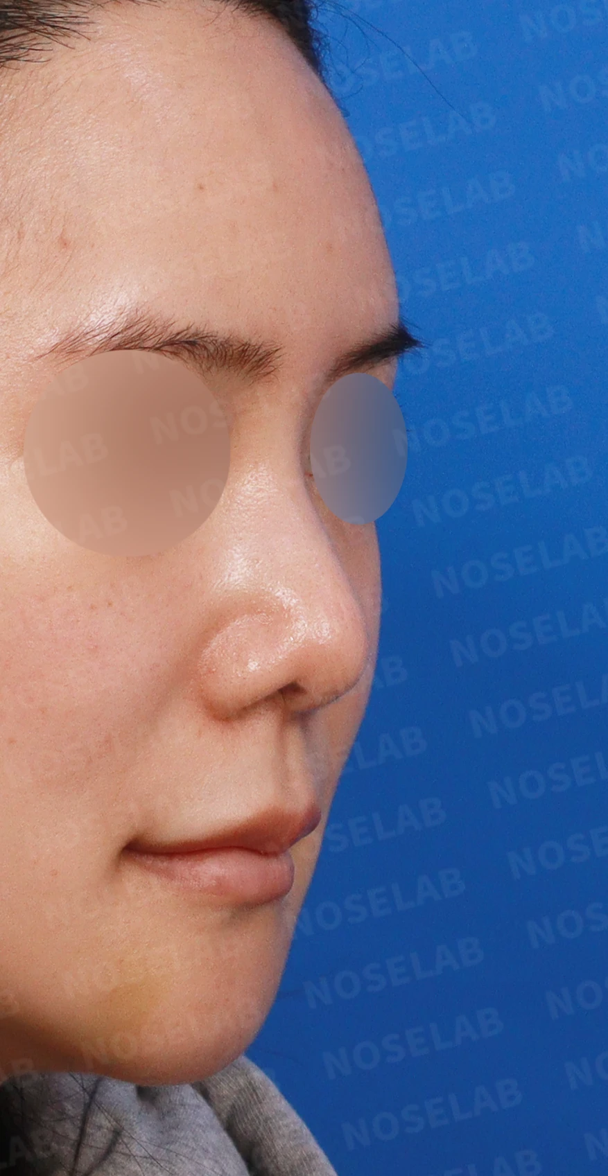 들린 코와 한쪽만 찝힌 콧구멍이 생기는 이유, 무보형물 재건은 어떻게 하나 — 디자인 상담 우측 측면, 비스듬한 측면, 비공 사진입니다.