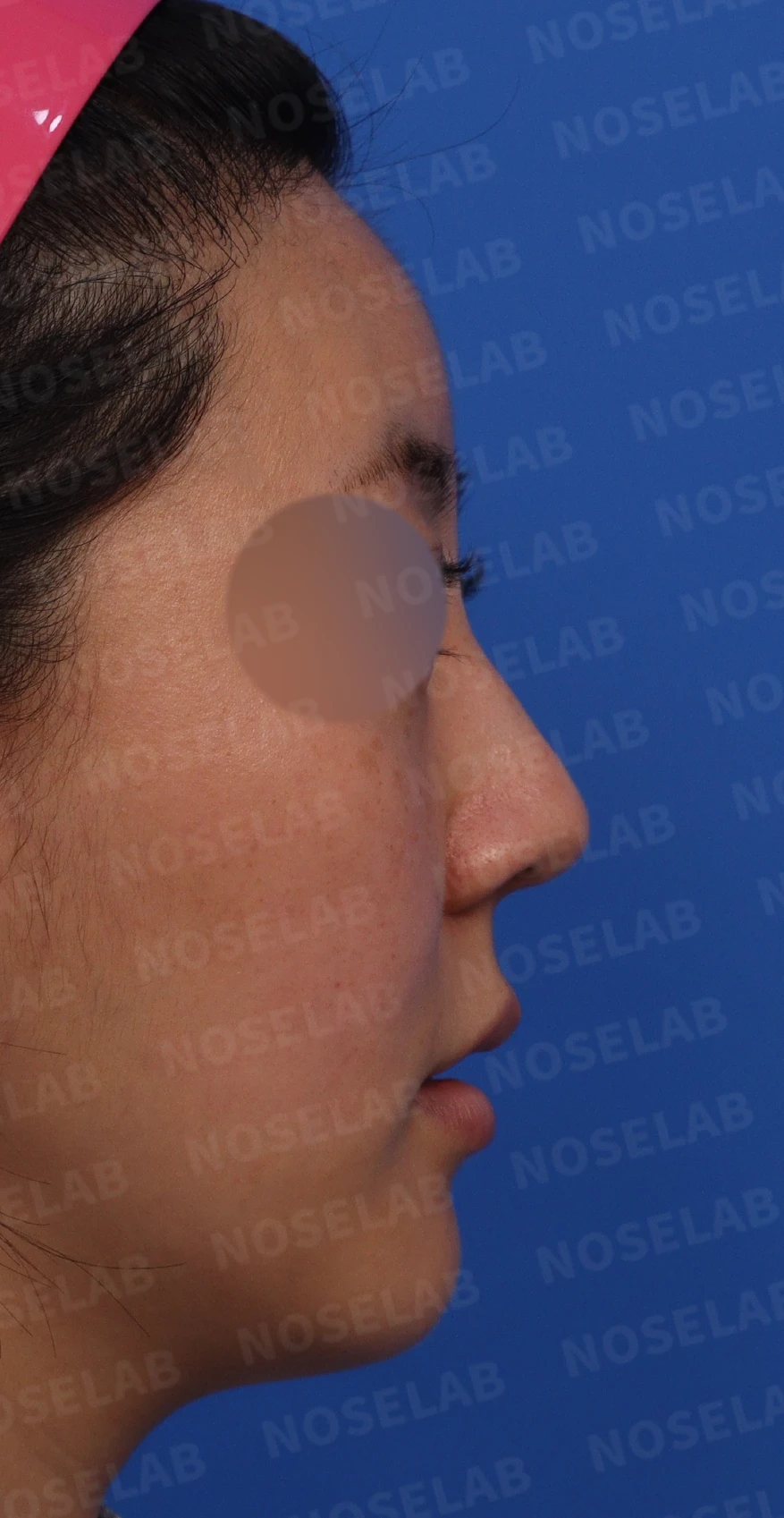 매부리코와 코끝의 모양을 함께 교정하는 방법 — 본문 사진 2