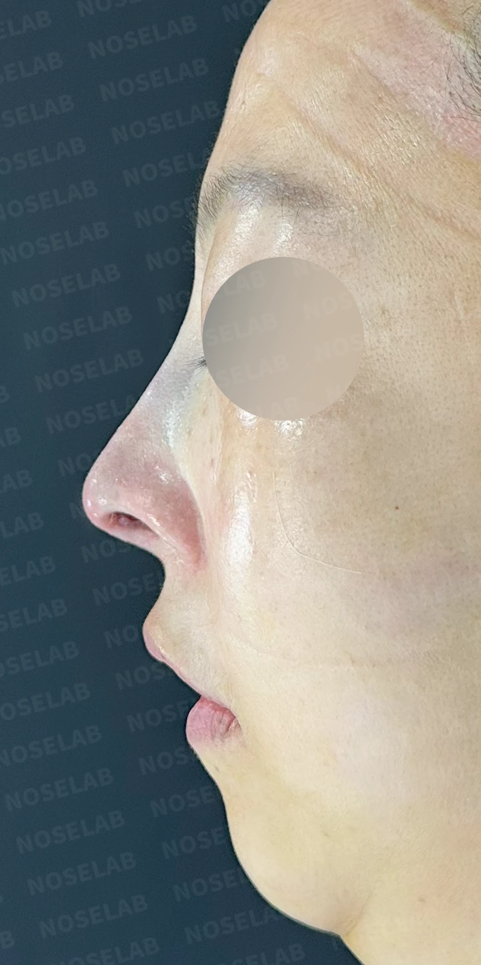 들창코에서 콧구멍이 많이 보이는 이유, 코끝 위치 교정은 어떻게 하나 — 수술 직후 0일 정면, 측면, 비스듬한 측면 사진 직후 사진은 부기가 있는 상태로 최종 결과와 다를 수 있습니다.
