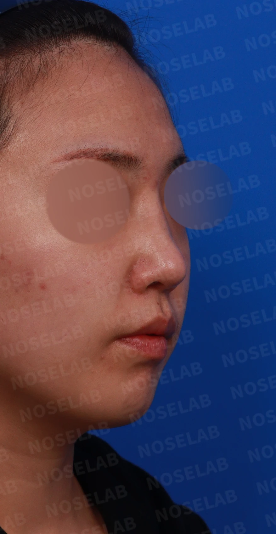 휘어진 코 교정과 비염 개선 - 자가늑연골 재건술 후기 — 디자인 상담 우측 비스듬한 측면, 측면, 비공 사진입니다.