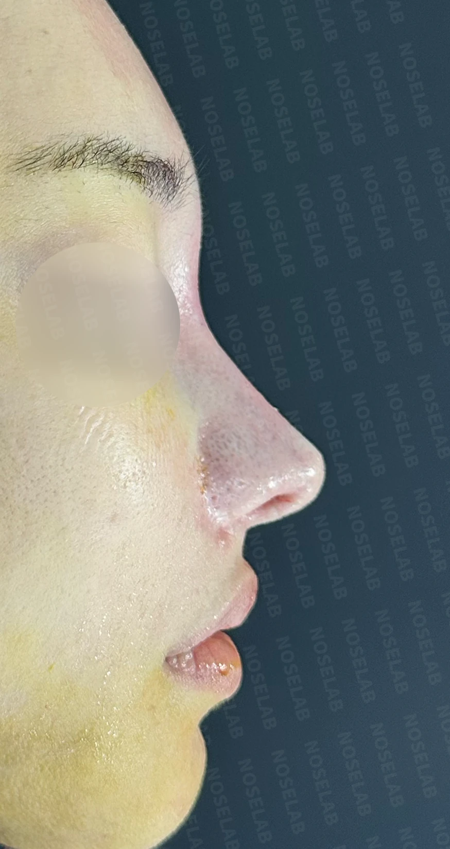 복코·휜코·들린코 교정 방법 — 수술 직후 0일 사진 정면, 비스듬한 측면, 측면 직후 사진은 부기가 있는 상태로 최종 결과와 다를 수 있습니다.