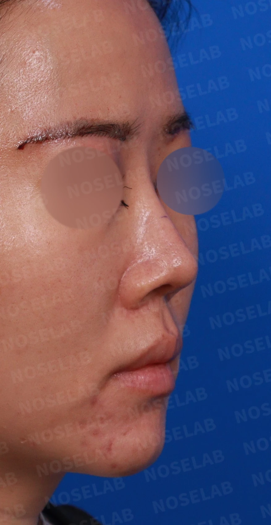 비주 내리기와 비순각 교정을 함께 계획하는 방법 — 디자인 상담 우측 측면, 비스듬한 측면, 비공 사진입니다.