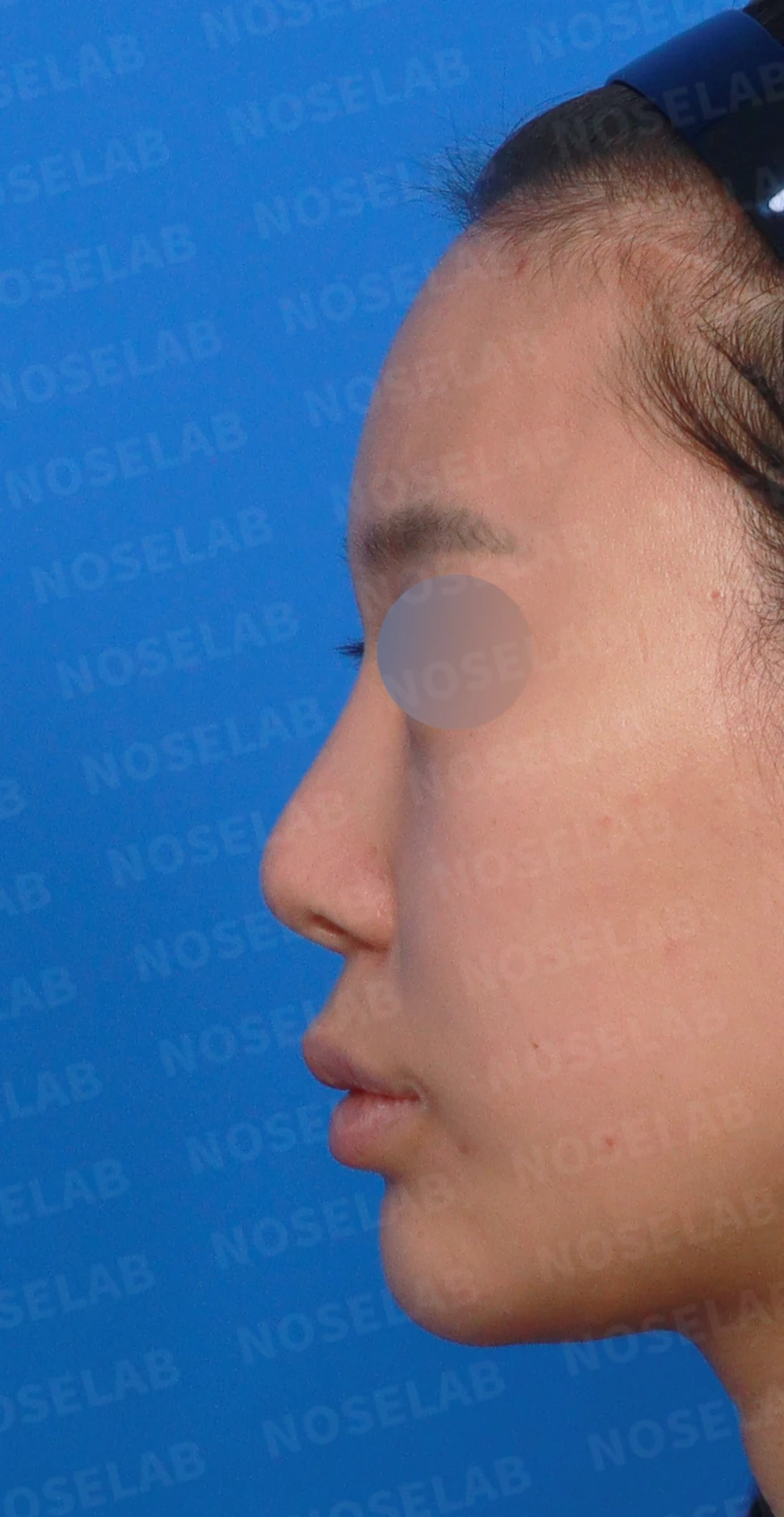 비중격 천공이 생기면 무엇이 문제이고 어떻게 재건하나 — 디자인 상담 정면, 좌측 측면, 비스듬한 측면 사진입니다.