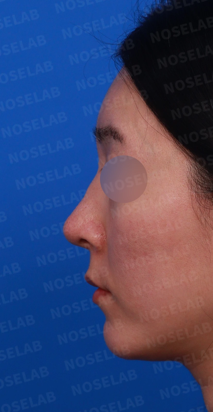 외측절골 후 코막힘과 비대칭을 살펴보는 교정 방법 — 디자인 상담 정면, 좌측 측면, 비스듬한 측면 사진