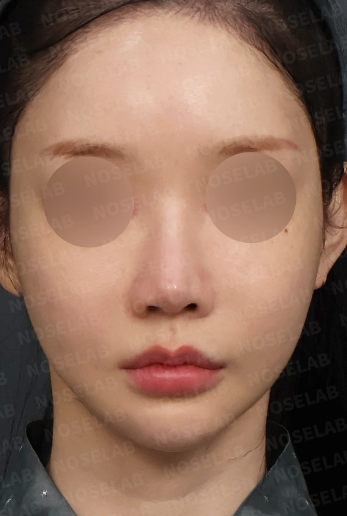 여러 차례 코수술 후 자가늑연골과 자가진피로 코 전체를 자연스럽게 높인 재수술 — 디자인 상담 정면, 좌측 측면, 비스듬한 측면 사진입니다.