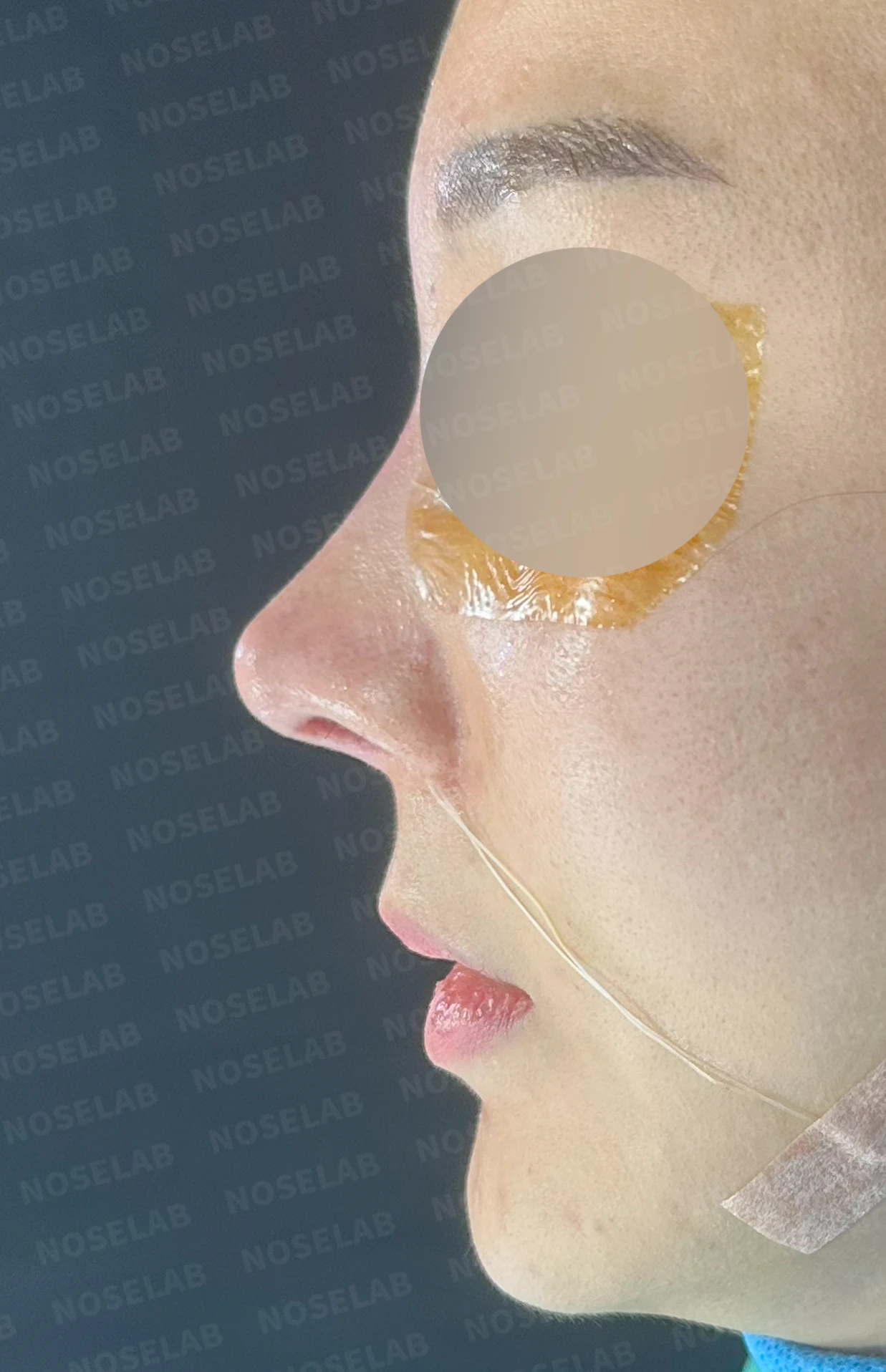 코가 휘어 보이고 비주가 한쪽으로 기우는 이유, 교정은 어떻게 하나 — 수술 직후 0일 정면, 측면, 비스듬한 측면 사진 직후 사진은 부기가 있는 상태로 최종 결과와 다를 수 있습니다.