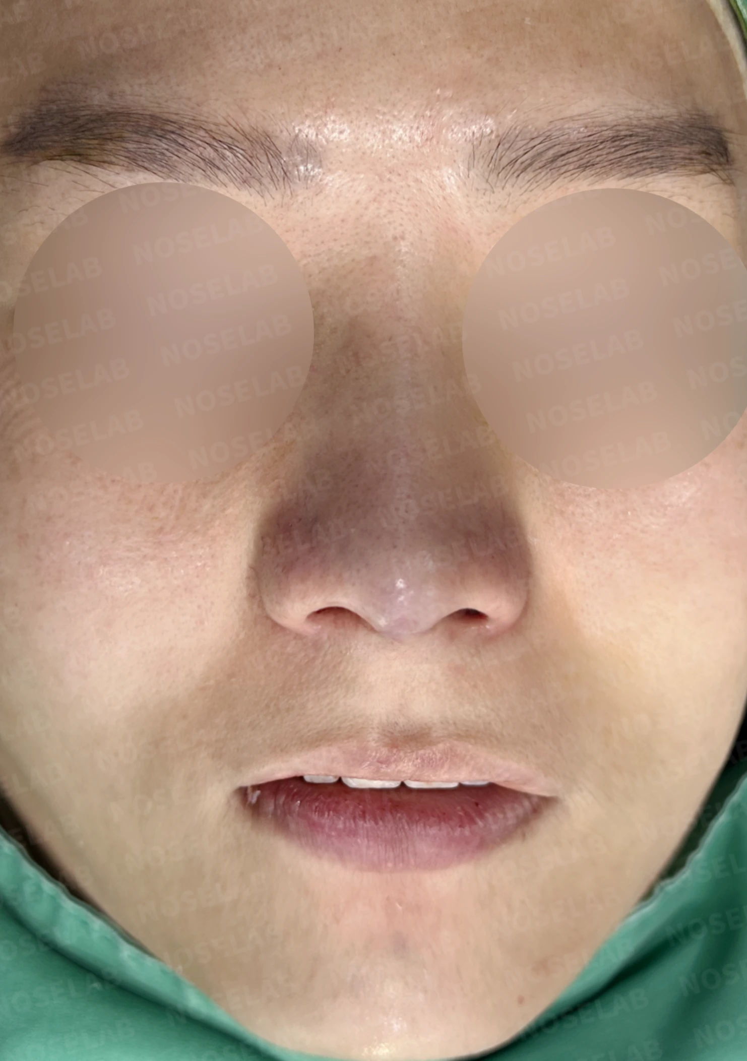 한쪽 비골이 함몰되면 왜 코가 휘어 보이는가, 절골 복원과 비중격 재건 — 수술 직후 0일 정면, 비스듬한 측면, 측면 사진 직후 사진은 부기가 있는 상태로 최종 결과와 다를 수 있습니다.