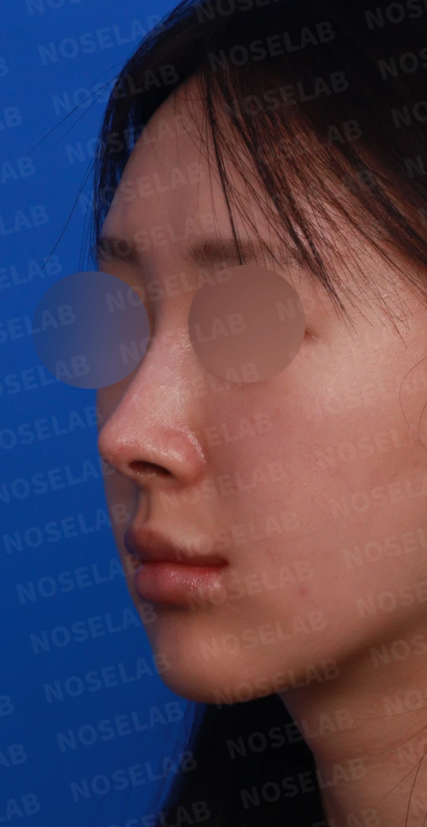 뾰족한 코끝과 연골 비침 - 자가진피 코 재수술 후기 — 디자인 상담 정면, 좌측 측면, 비스듬한 측면 사진