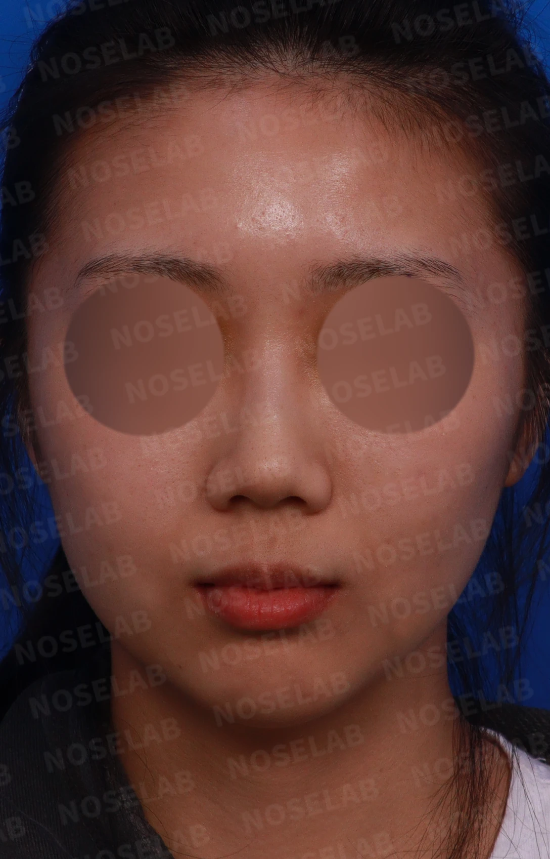 작은 코와 비공 비대칭을 함께 살펴보는 교정 방법 — 본문 사진 1