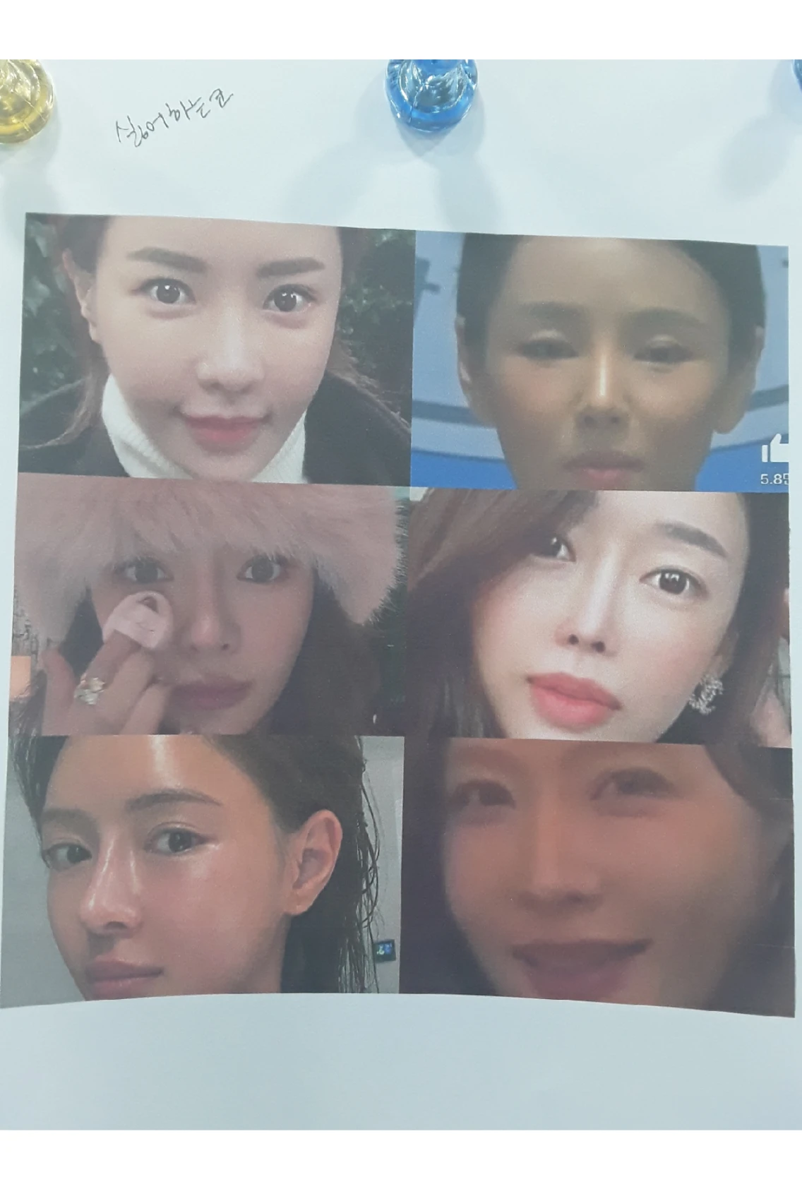 이식한 진피가 반복해서 흡수되는 이유, 재건은 어떻게 하나 — 1. 환자분이 좋아하는 코 2. 환자분이 싫어하는 코