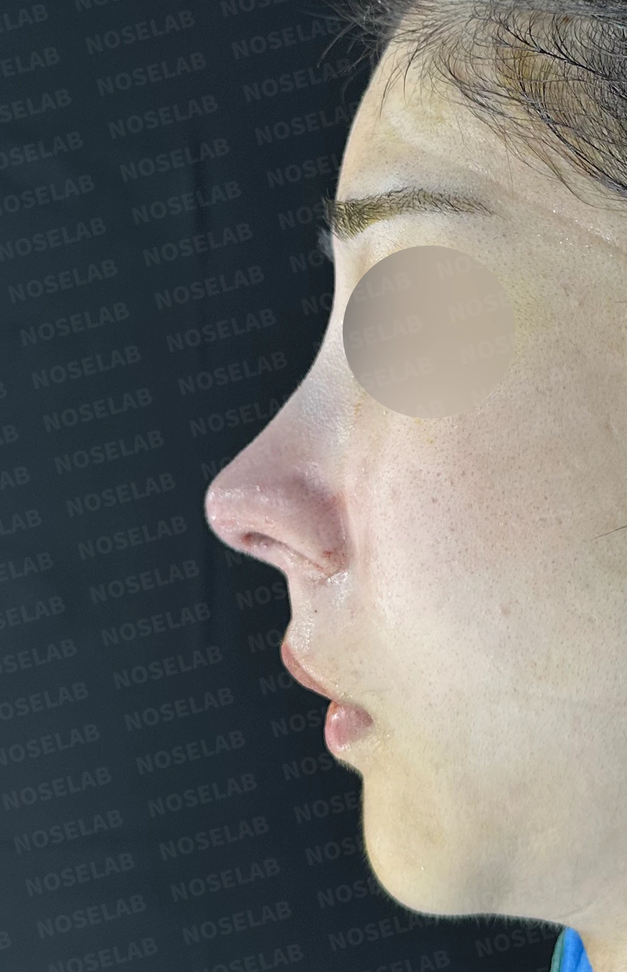 코가 뭉툭하고 퍼져 보이는 이유, 비순각과 비주는 어떻게 교정하나 — 수술 전 / 수술 직후 0일 직후 사진은 부기가 있는 상태로 최종 결과와 다를 수 있습니다.