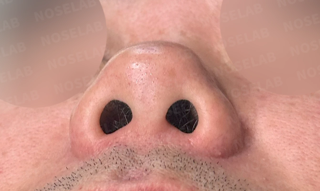 짧고 들린 코의 구조와 교정 방법 — 수술 전 / 수술 직후 0일 직후 사진은 부기가 있는 상태로 최종 결과와 다를 수 있습니다.