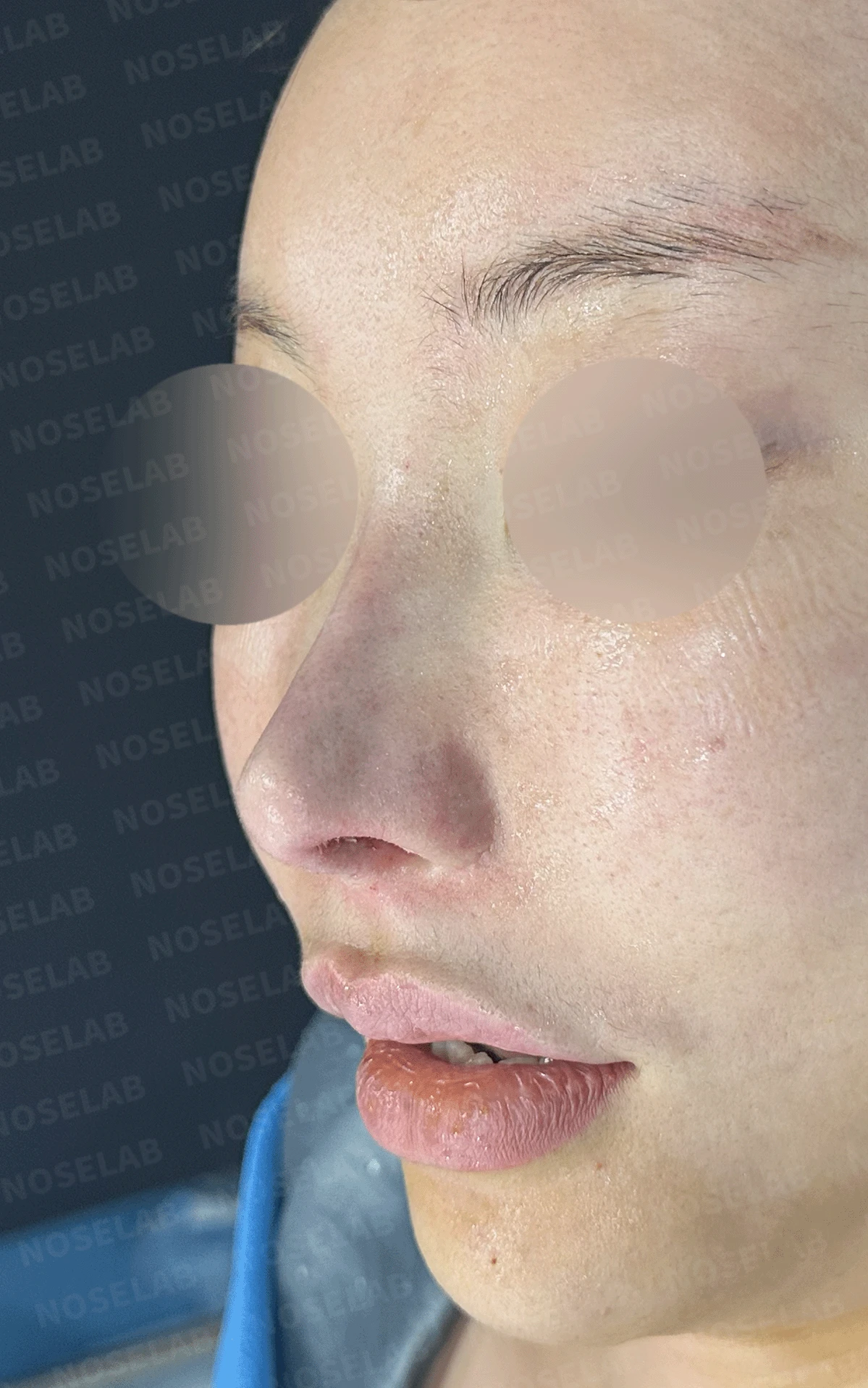 인공진피 이식 후 코끝이 비쳐 보이는 이유와 자가 늑연골 재건 방법 — 수술 직후 0일 정면 , 비스듬한 측면 , 측면 사진입니다. 직후 사진은 부기가 있는 상태로 최종 결과와 다를 수 있습니다.