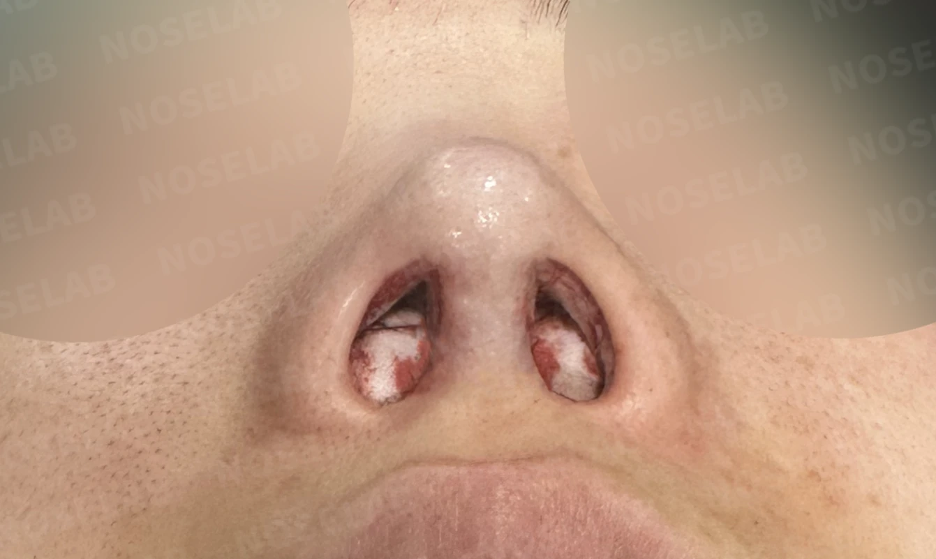 보형물 비침과 들린 코, 자가늑연골로 안전하게 교정한 코재수술 — 전(좌) 직후(후)