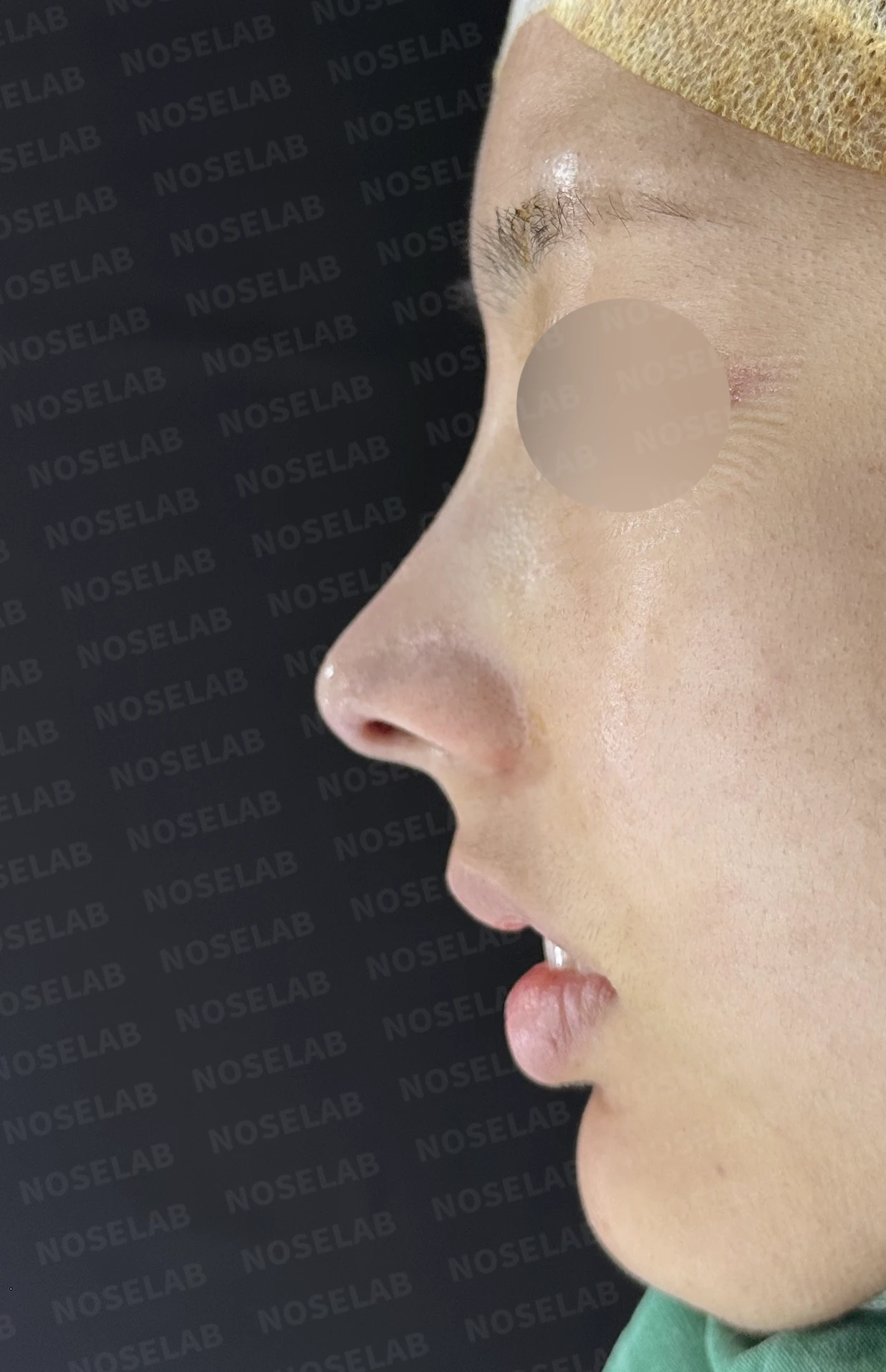 휘어진 매부리와 처진 코끝이 생기는 이유, 비중격 연장술은 어떻게 하나 — 수술 직후 0일 정면, 비스듬한 측면, 측면 사진입니다. 직후 사진은 부기가 있는 상태로 최종 결과와 다를 수 있습니다.