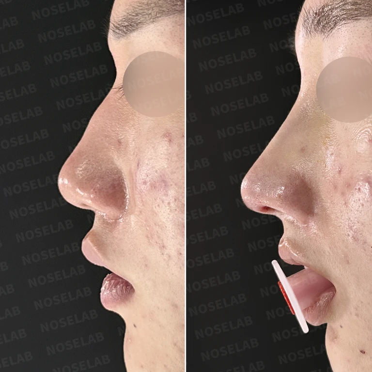휜코 매부리코 교정, 남자 코성형으로 자연스러운 변화 — 전후 비교
