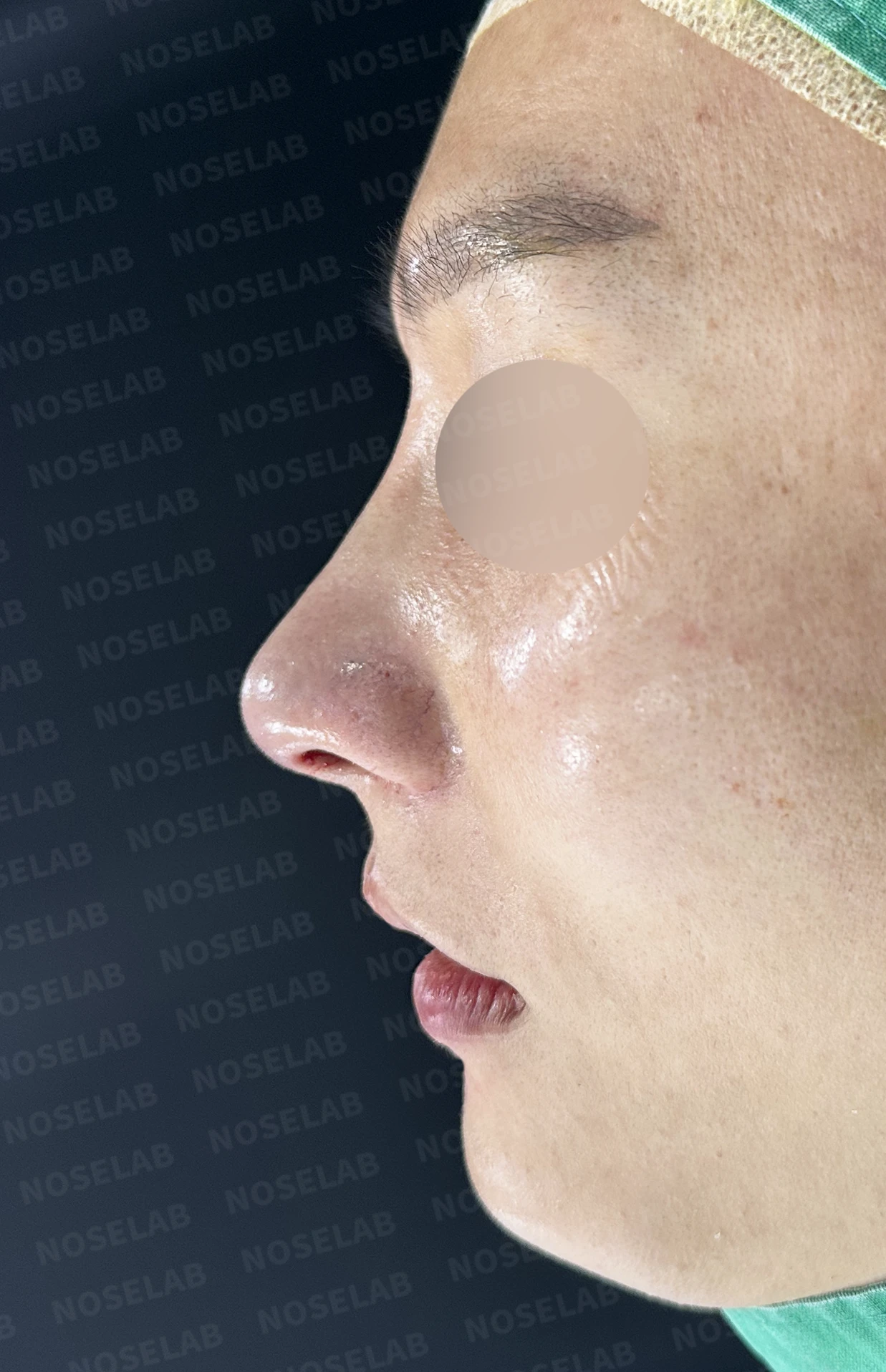 한쪽 비골이 함몰되면 왜 코가 휘어 보이는가, 절골 복원과 비중격 재건 — 수술 전 / 수술 직후 0일 직후 사진은 부기가 있는 상태로 최종 결과와 다를 수 있습니다.